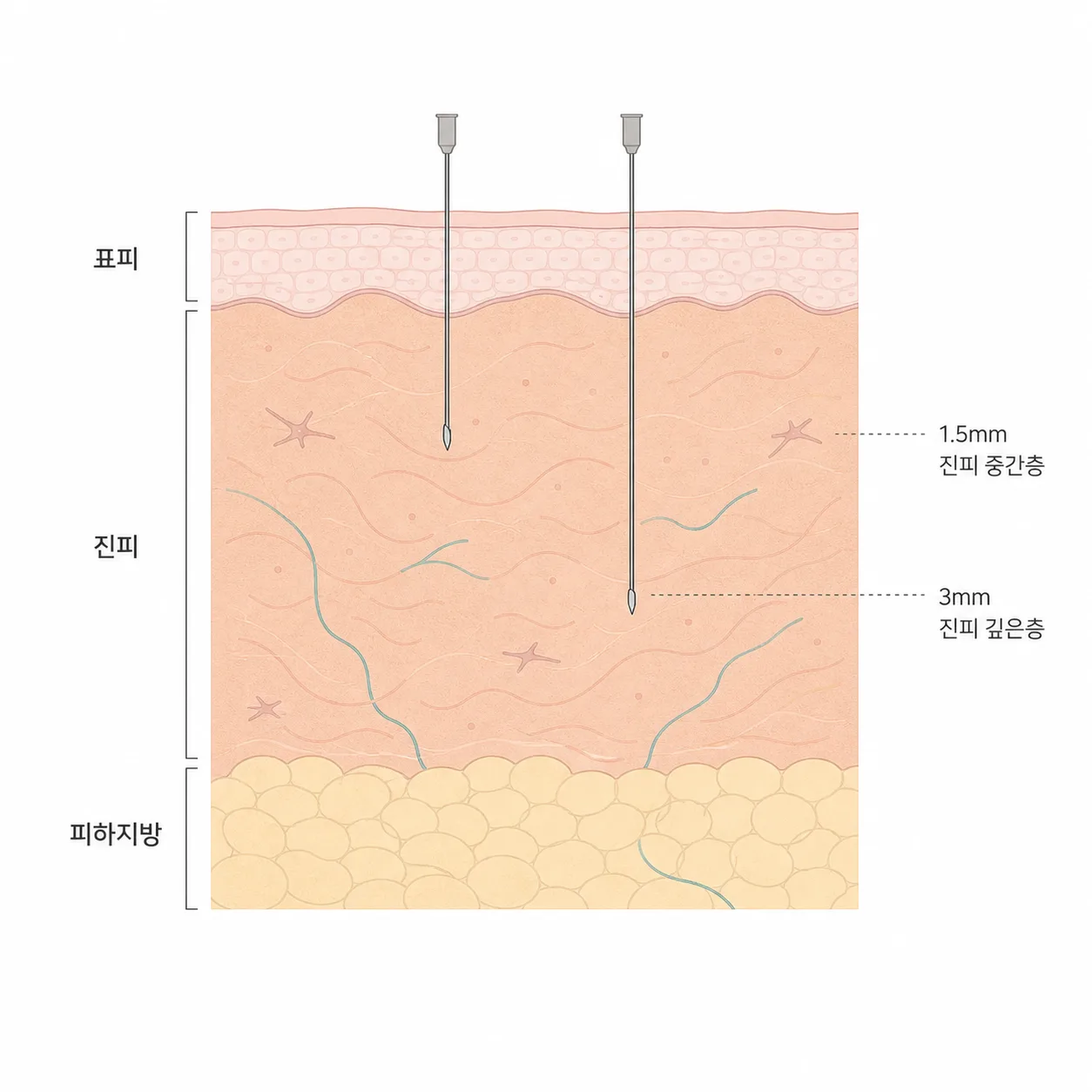 표피와 진피, 주입 깊이가 갈리는 자리
