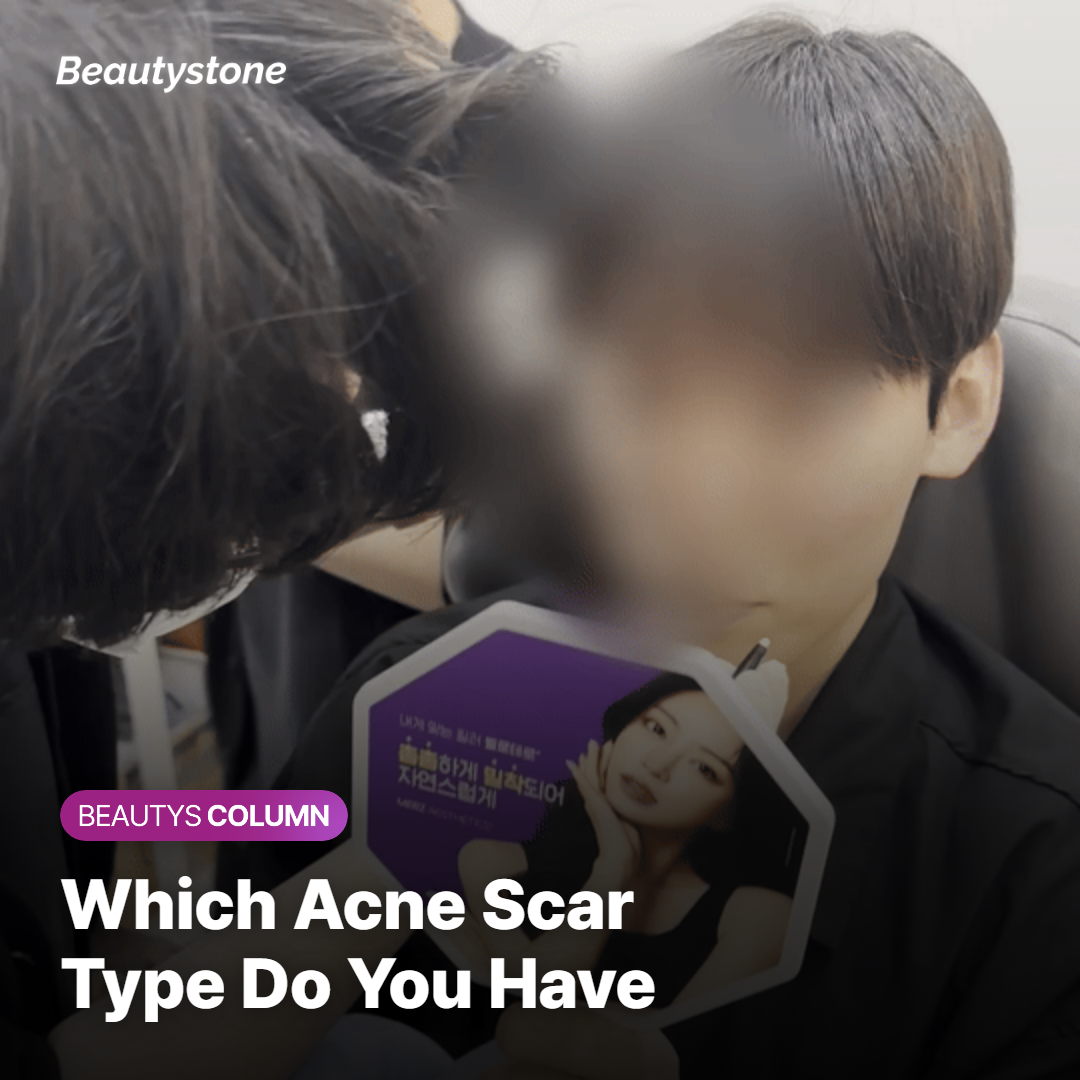 What Kind of Acne Scar Do You Have?