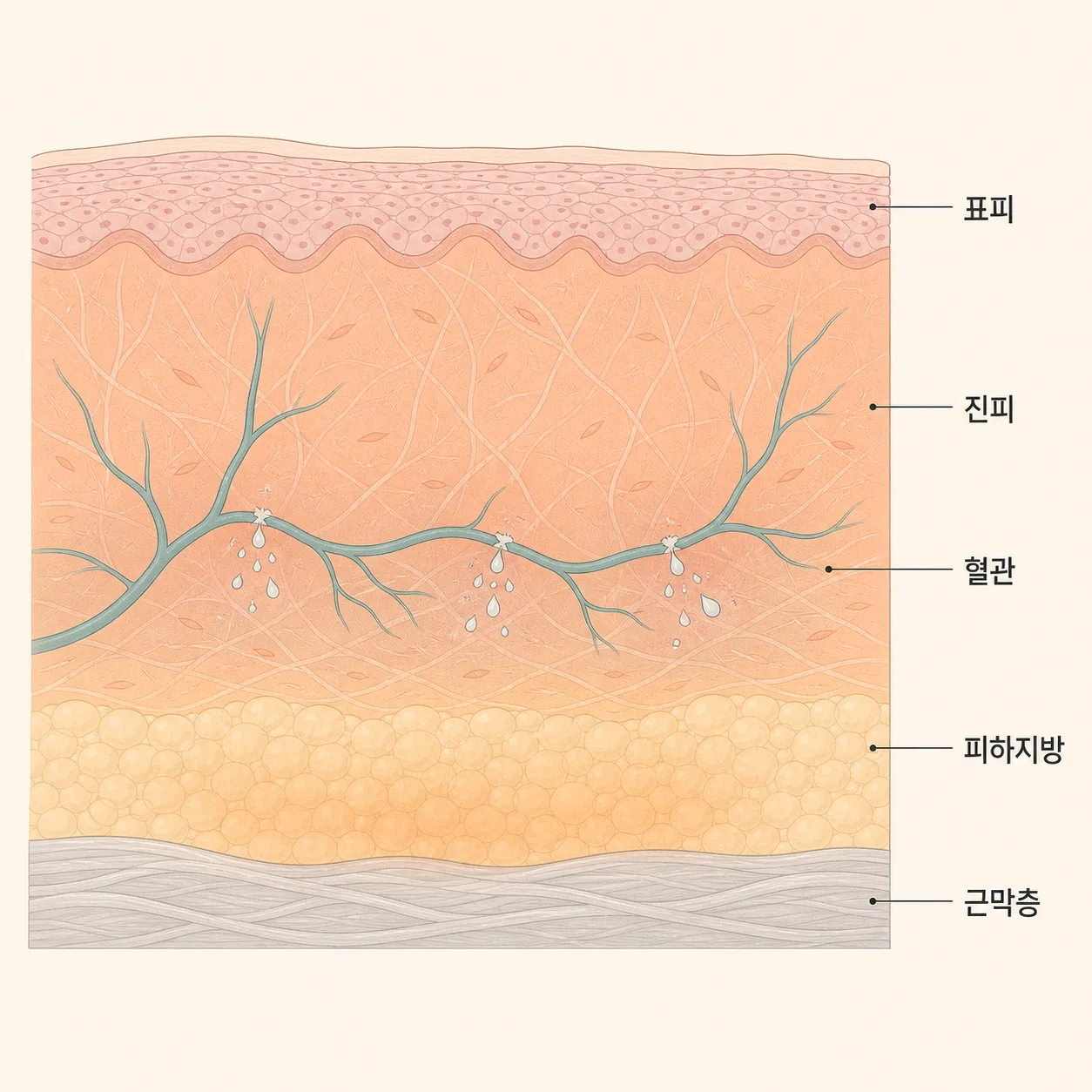 열이 닿는 층과 붓기가 생기는 자리