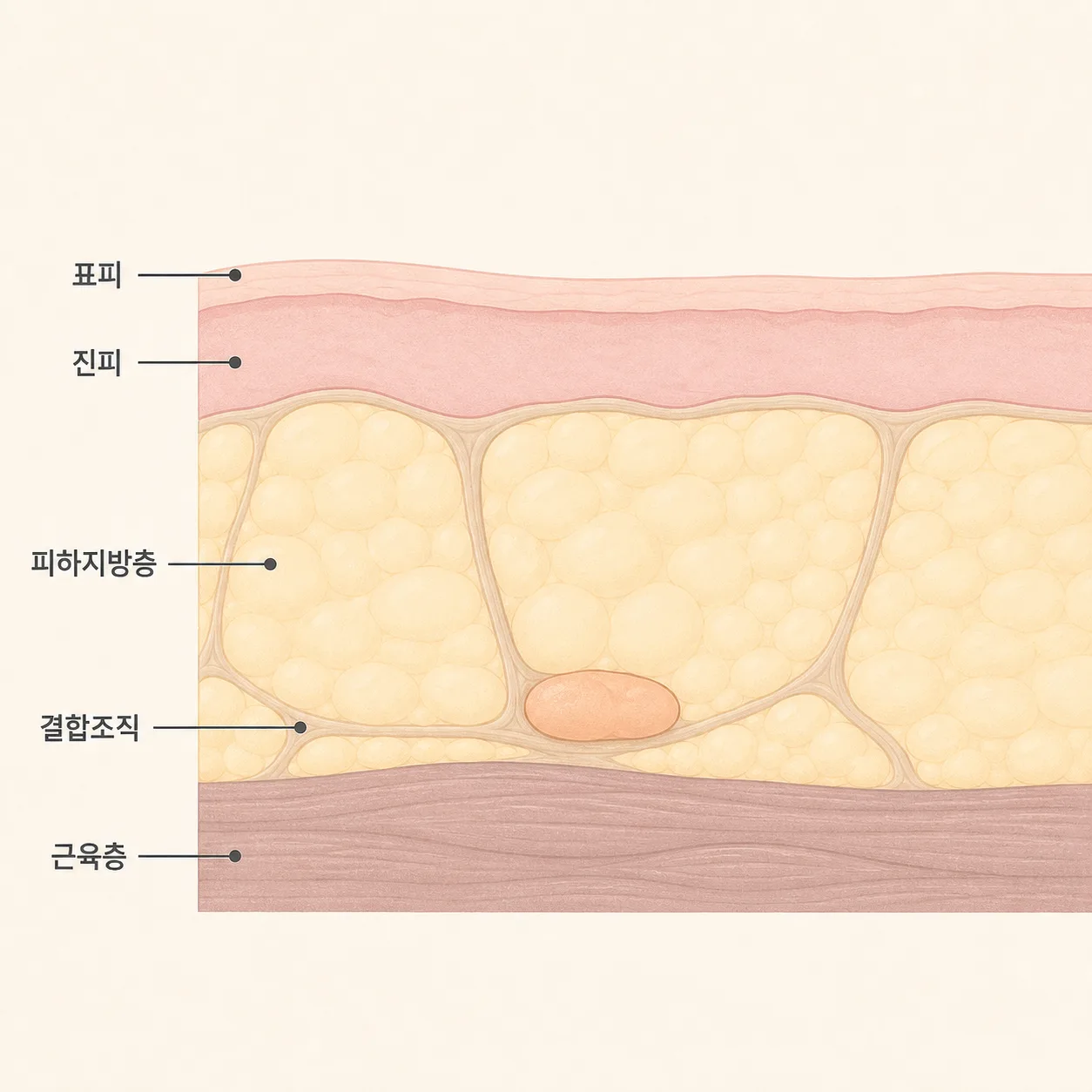 힙 필러가 자리를 잡는 피하지방층과 결합조직