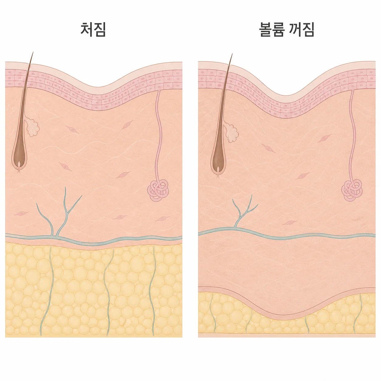 처짐과 볼륨 꺼짐이 만드는 골의 차이