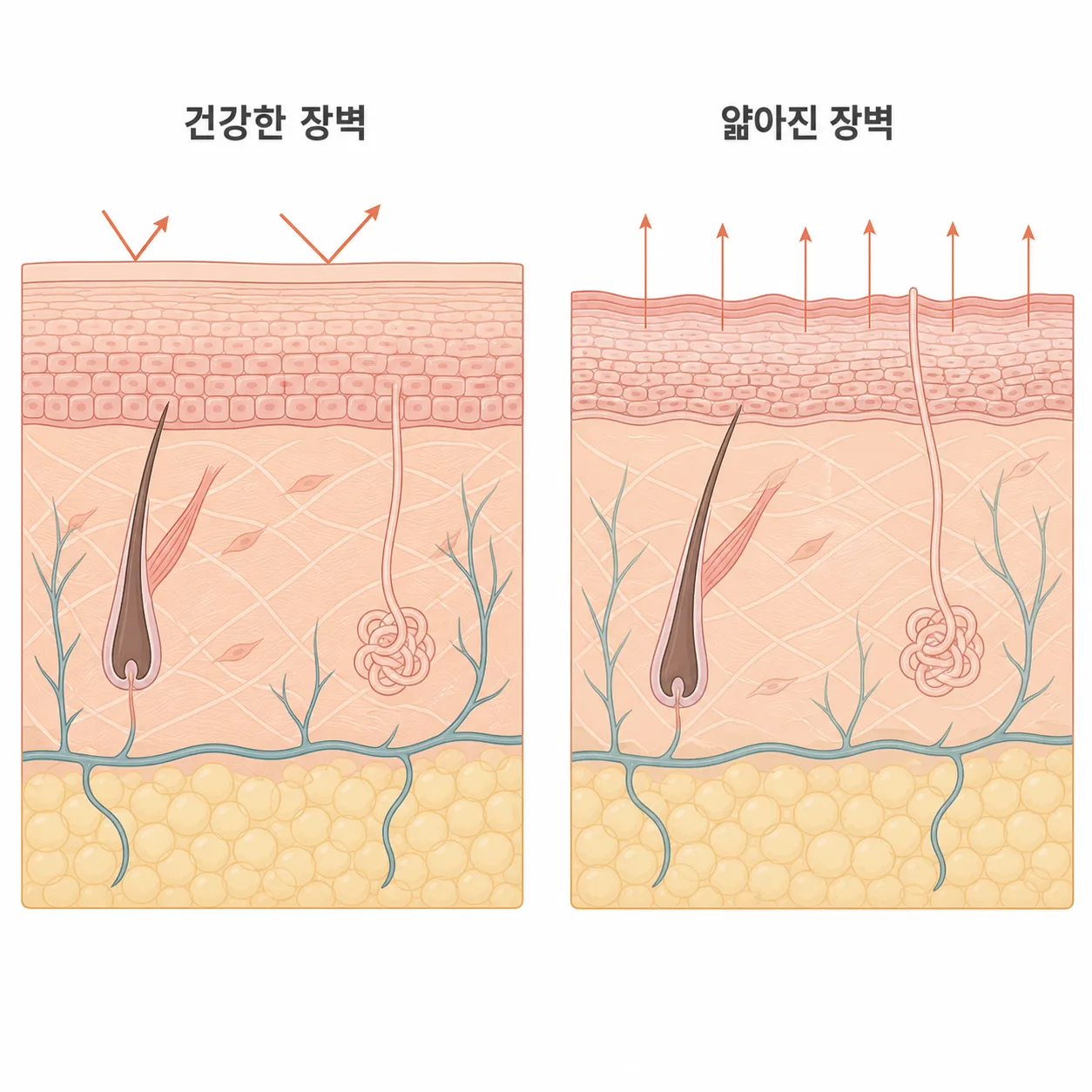 장벽이 건강할 때와 얇아졌을 때의 차이