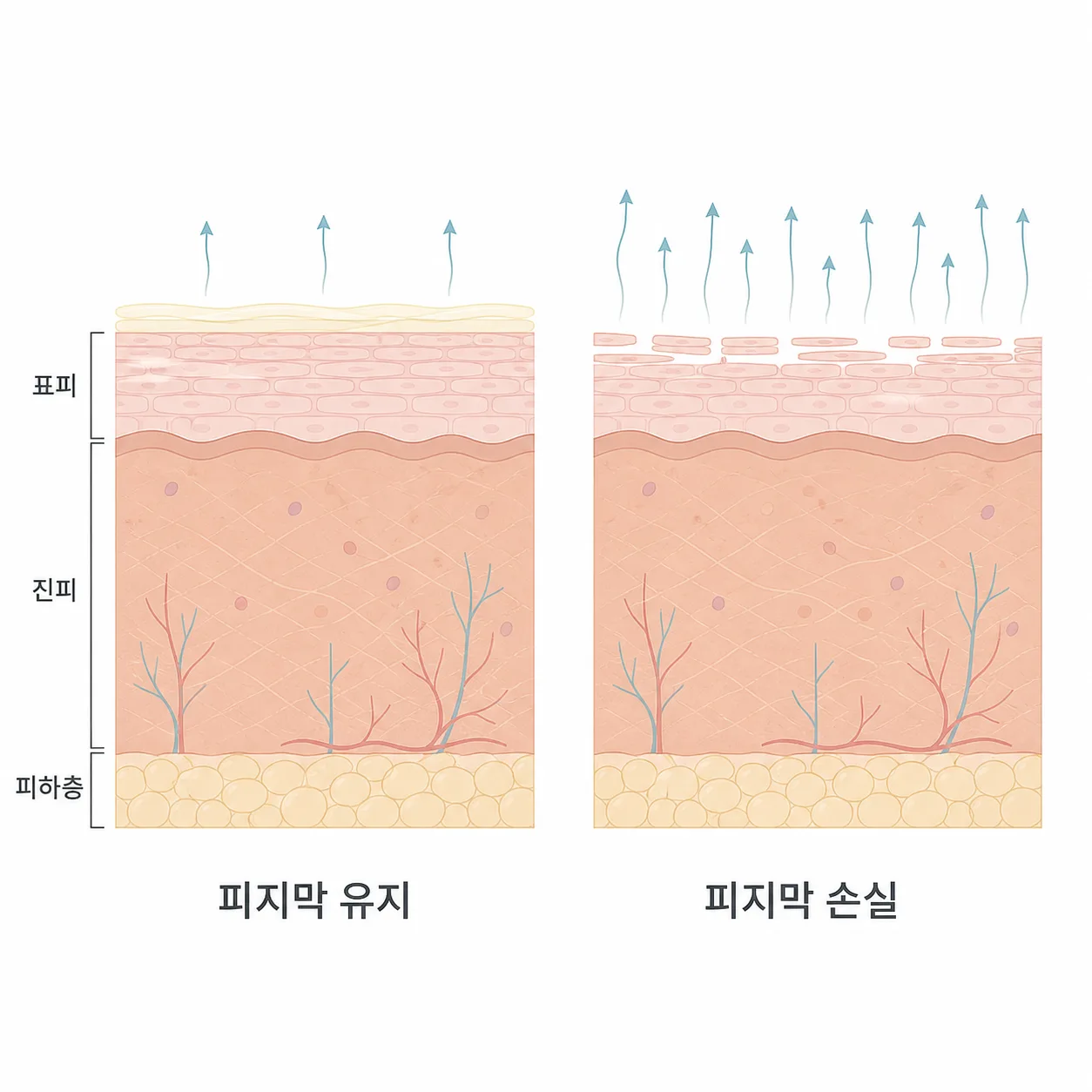 피지막이 남아 있을 때와 걷혔을 때