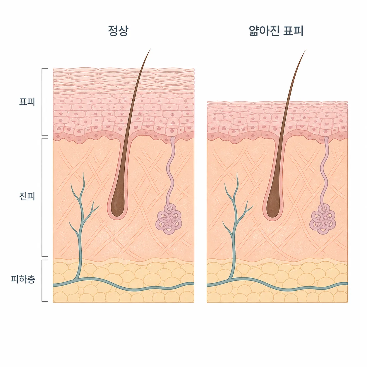 각질층이 얇아진 피부와 평소 피부의 차이