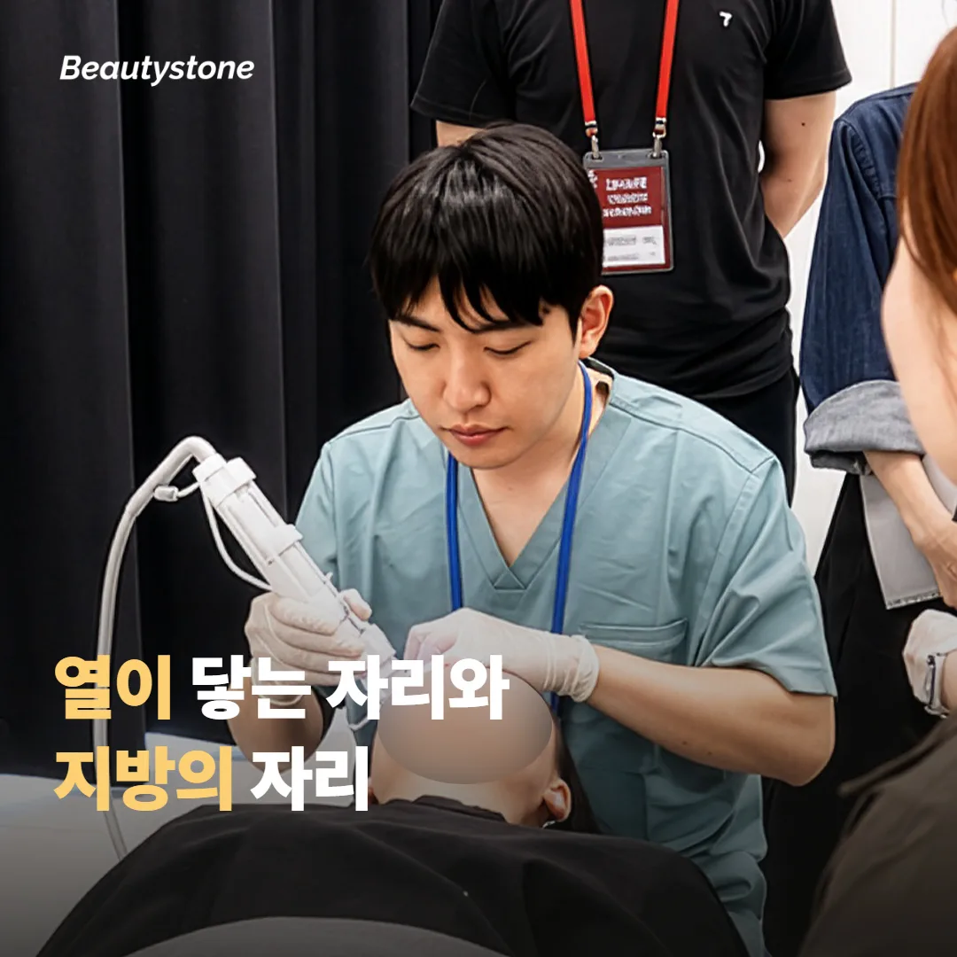 열은 어디에 닿고 이식 지방은 어디에 있나요