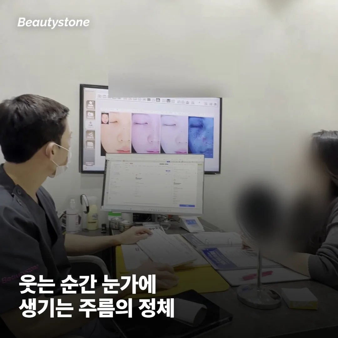 눈가 주름 보톡스, 눈웃음까지 같이 사라지는 이유