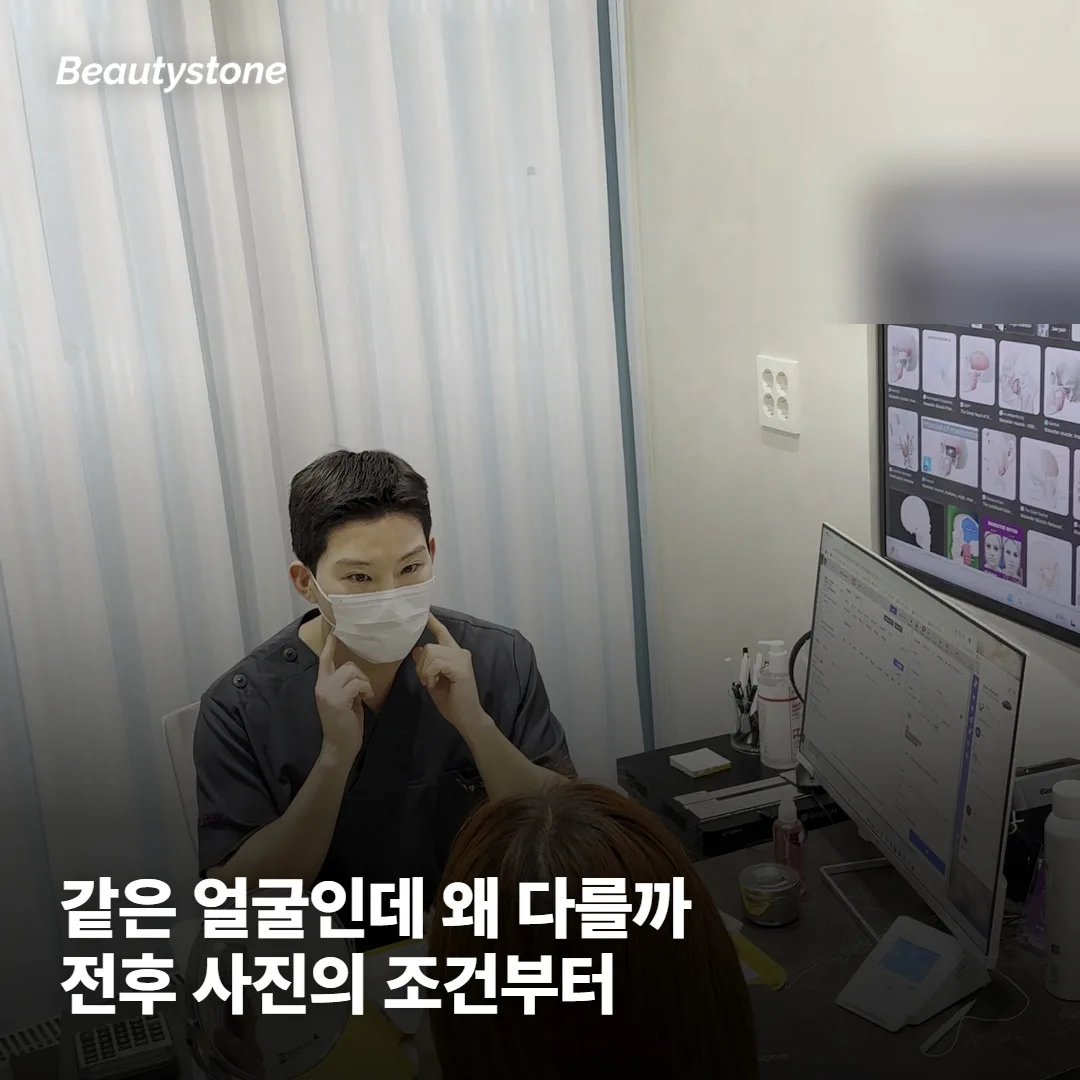 리쥬란 전후 사진, 왜 남의 사진만큼 극적이지 않을까요?