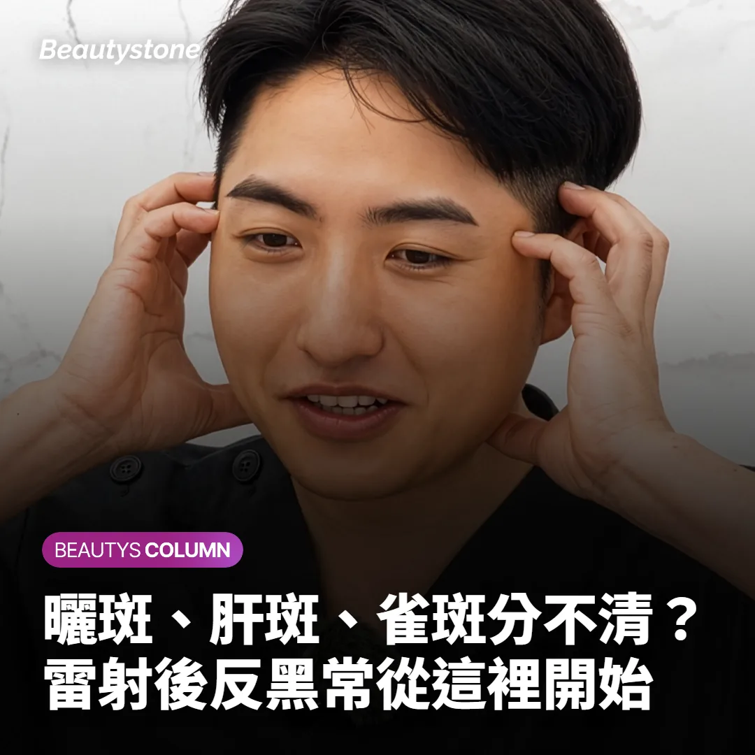 曬斑、肝斑、雀斑分不清？雷射後反黑常從這裡開始