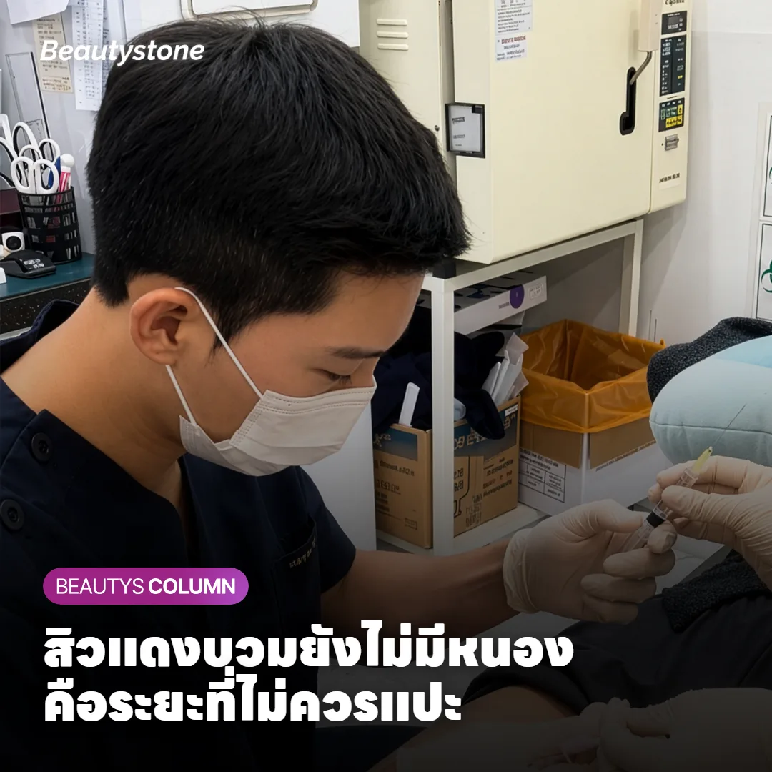 สิวแบบไหนที่ไม่ควรแปะ แล้วเพราะอะไร