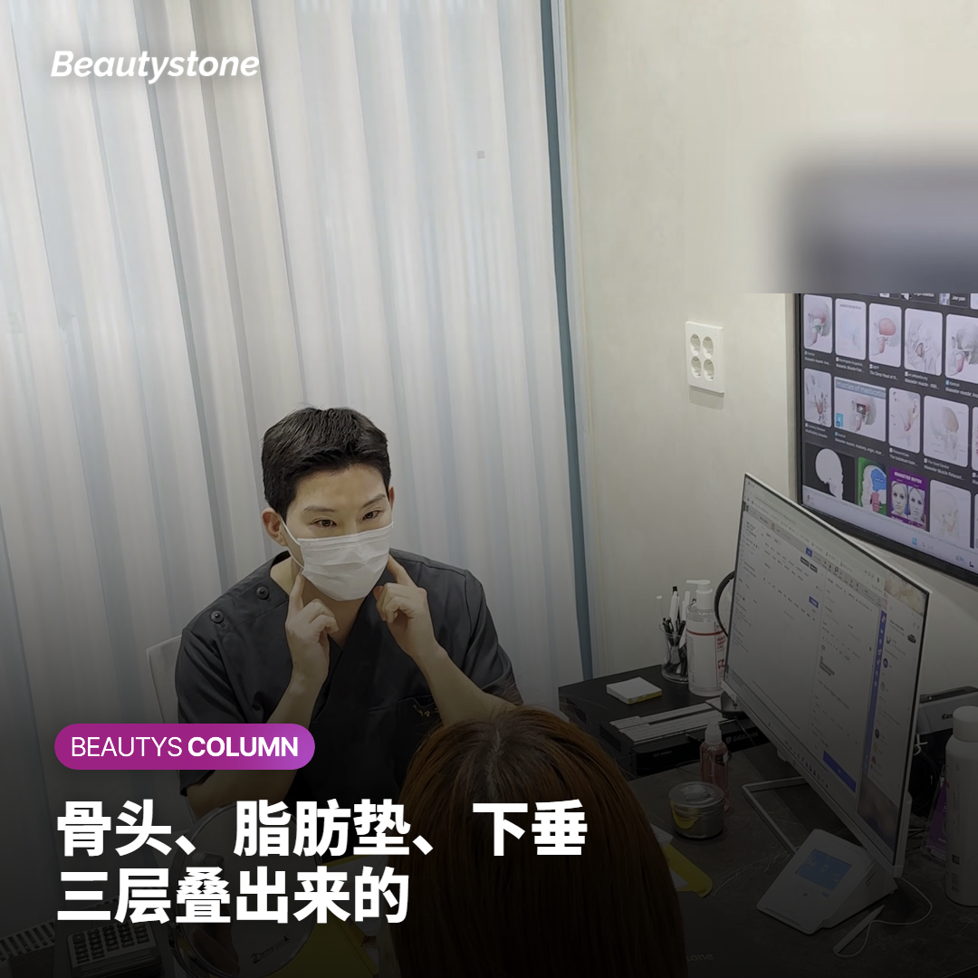 颧骨显大,是骨头、脂肪垫和下垂三层叠出来的