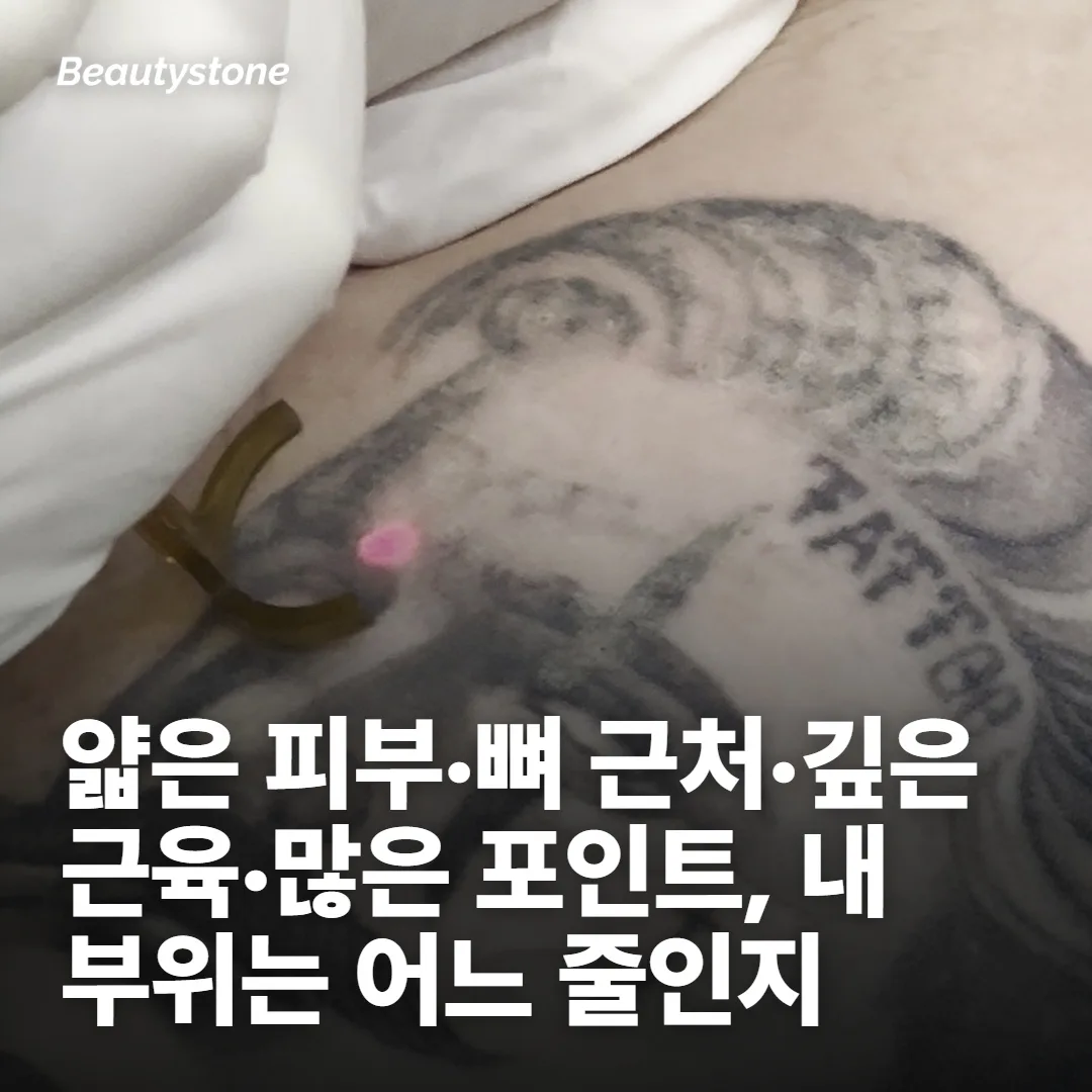 세 번째 갈래: 부위가 아픔을 가릅니다
