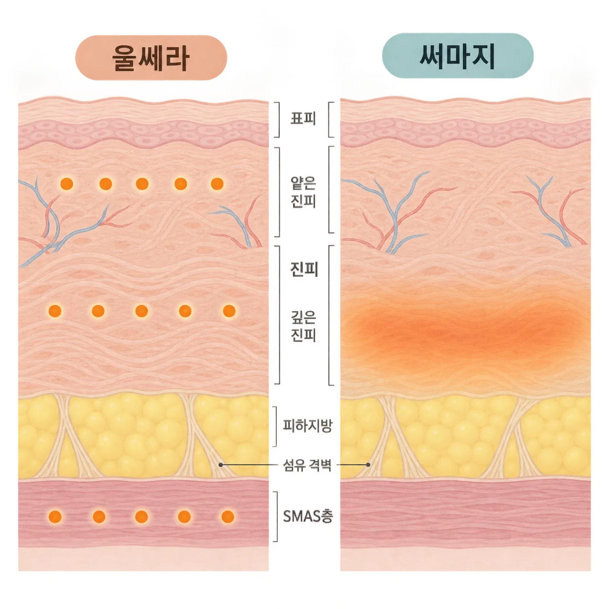 울쎄라가 층마다 점으로 모으는 자리와 써마지가 넓게 데우는 자리의 비교