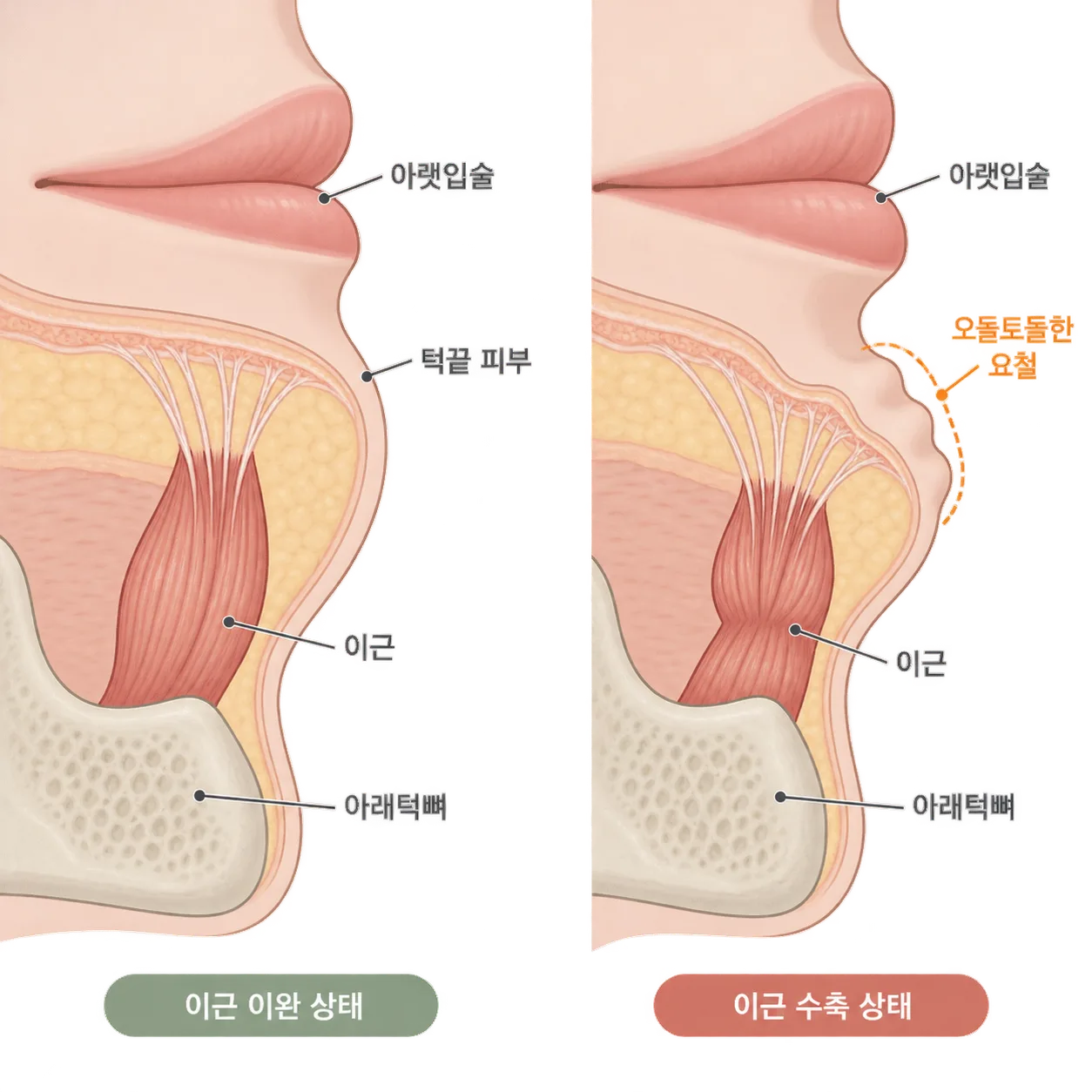 이근 가닥이 턱끝 피부에 붙어 있어서, 수축할 때 피부가 군데군데 당겨져요