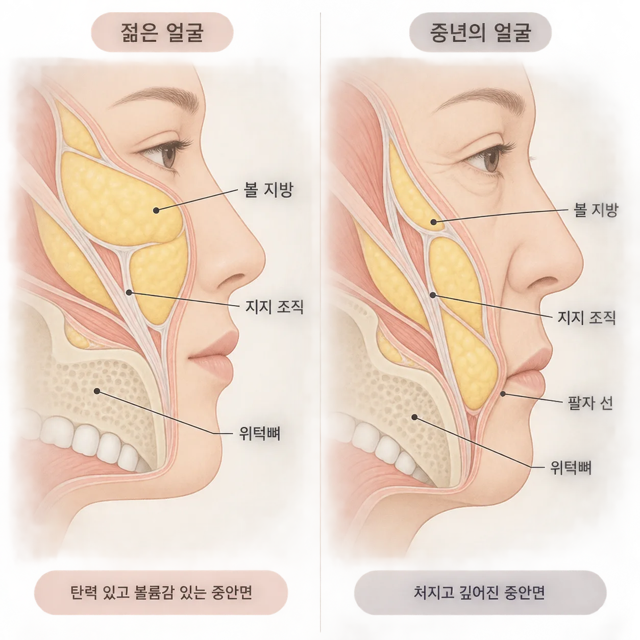 볼 지방과 지지 조직, 위턱뼈 변화가 겹쳐 팔자 그림자가 짙어지는 모습