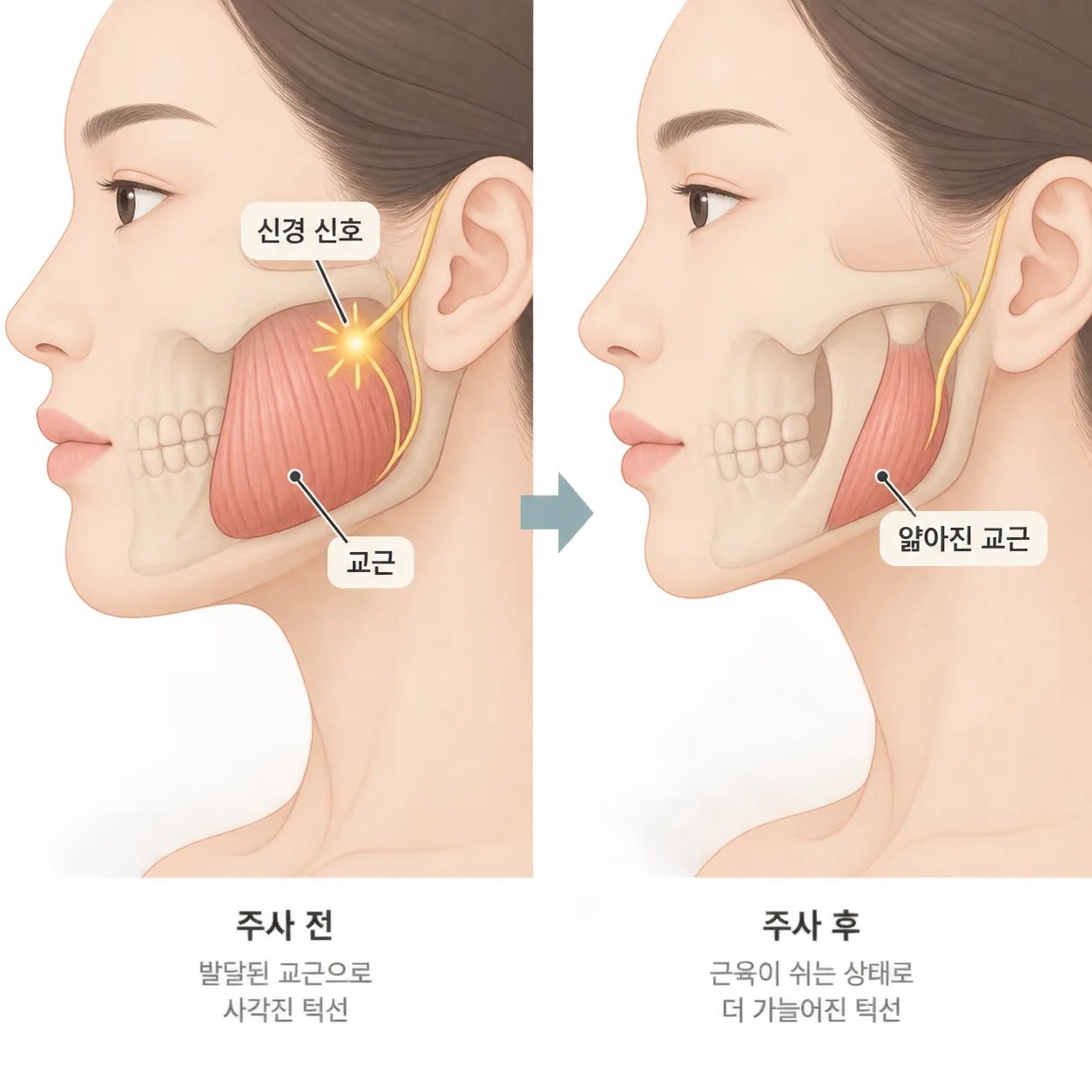 신호가 줄어든 뒤 교근이 얇아지며 턱선이 달라지는 순서