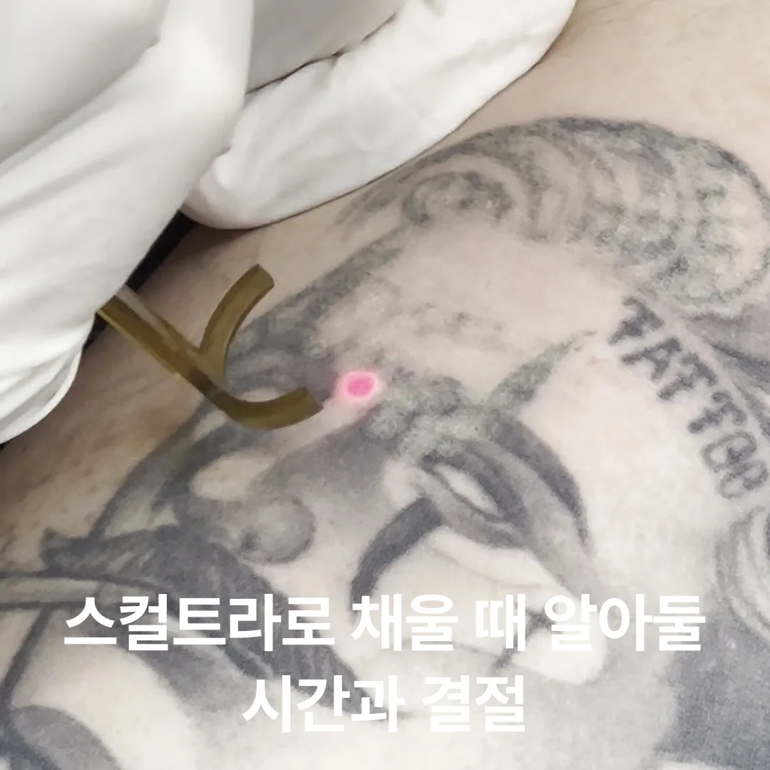 스컬트라로 채울 때 알아둘 시간과 결절