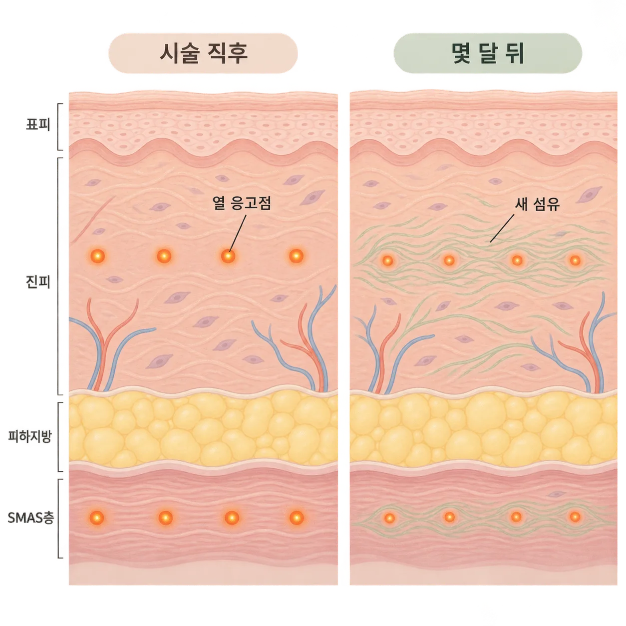 시술 직후 생긴 열 응고점 주변에 몇 달에 걸쳐 새 섬유가 채워지는 흐름