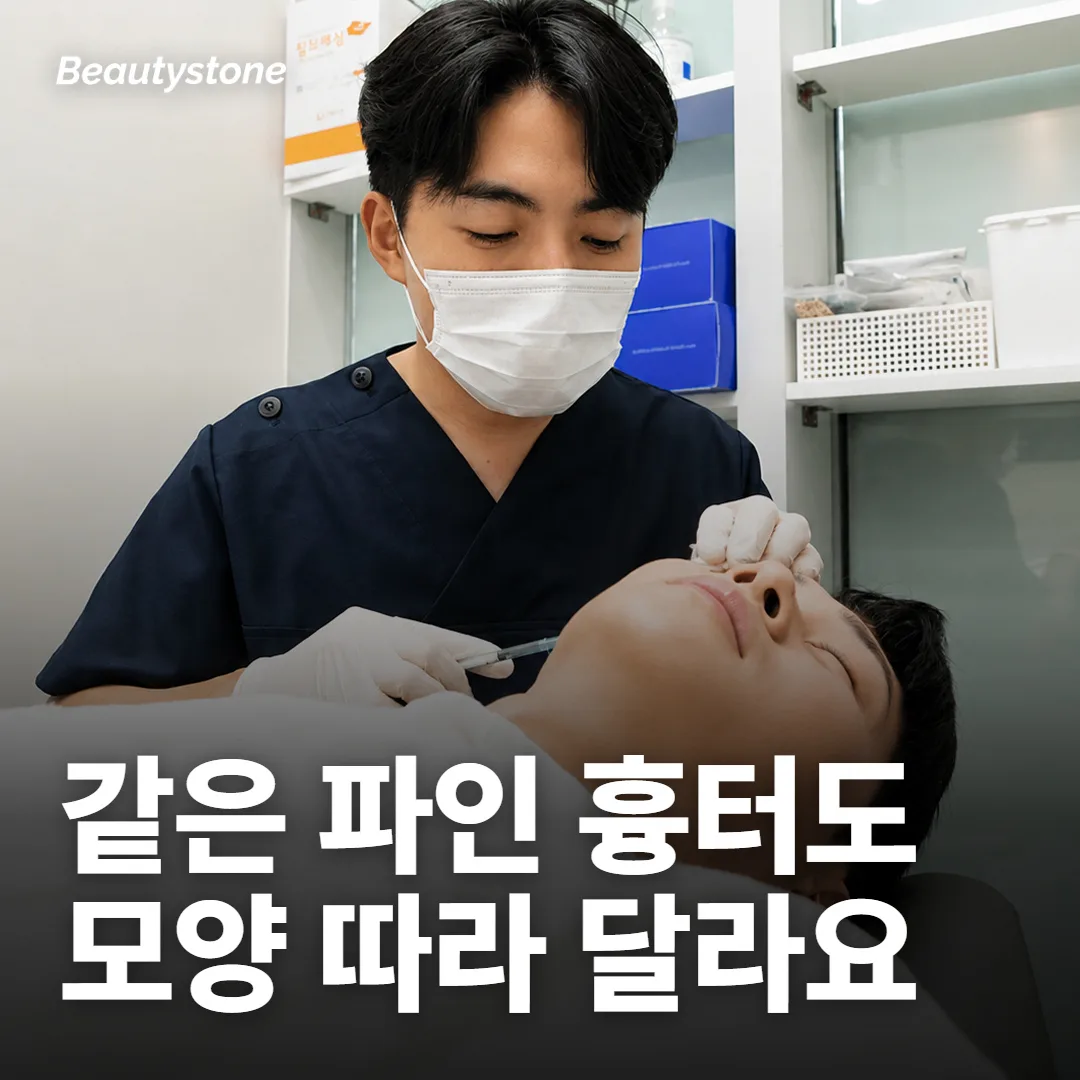 포텐자 효과는 흉터 모양에서 먼저 갈려요