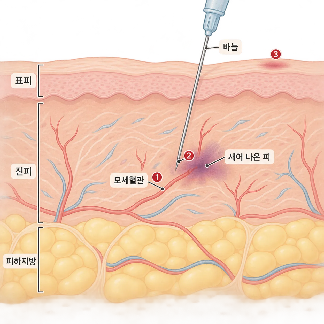 바늘이 모세혈관을 스쳐 새어 나온 피가 진피에 고이는 자리
