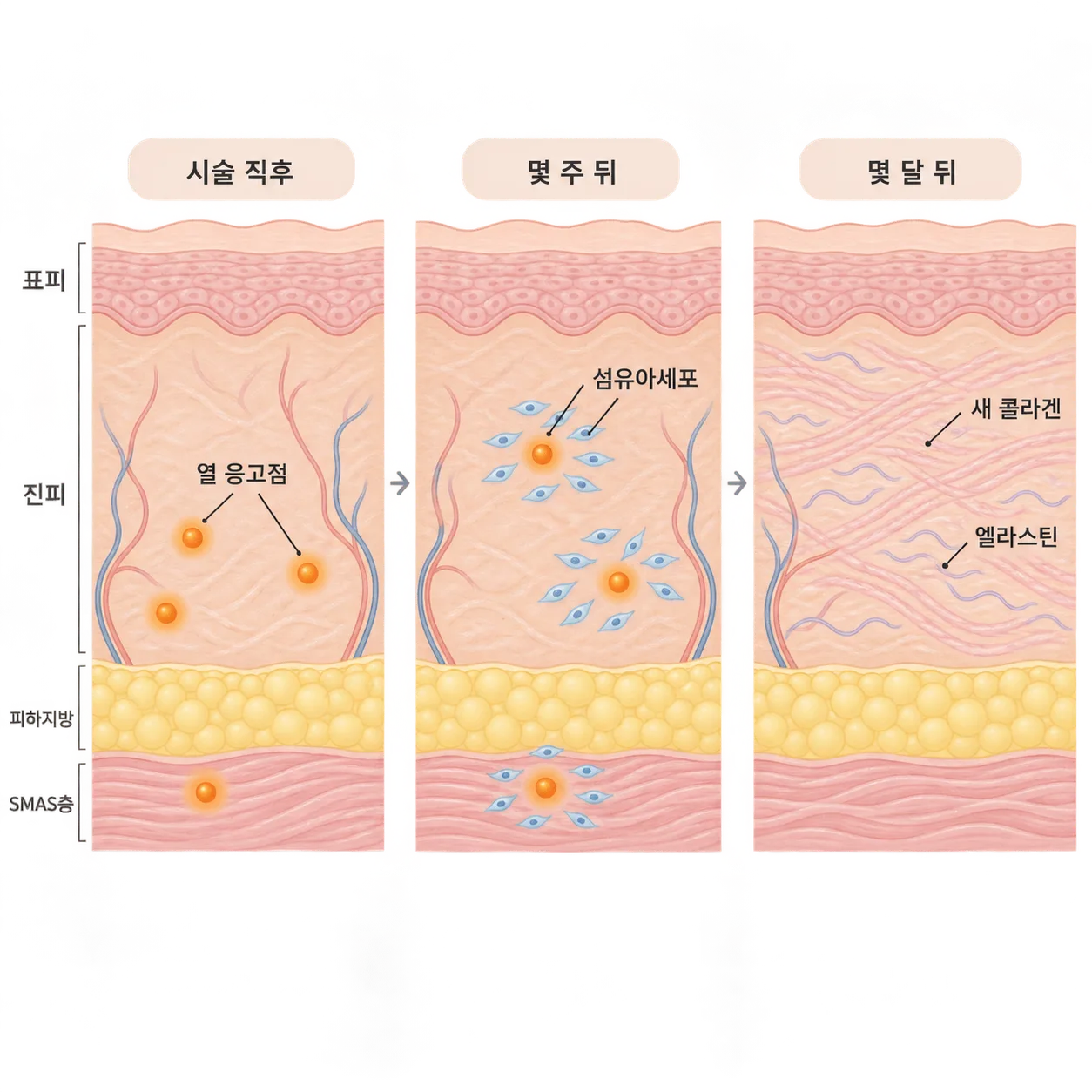 열 응고점 자리에 섬유아세포가 모이고 새 콜라겐과 엘라스틴이 차오르는 순서