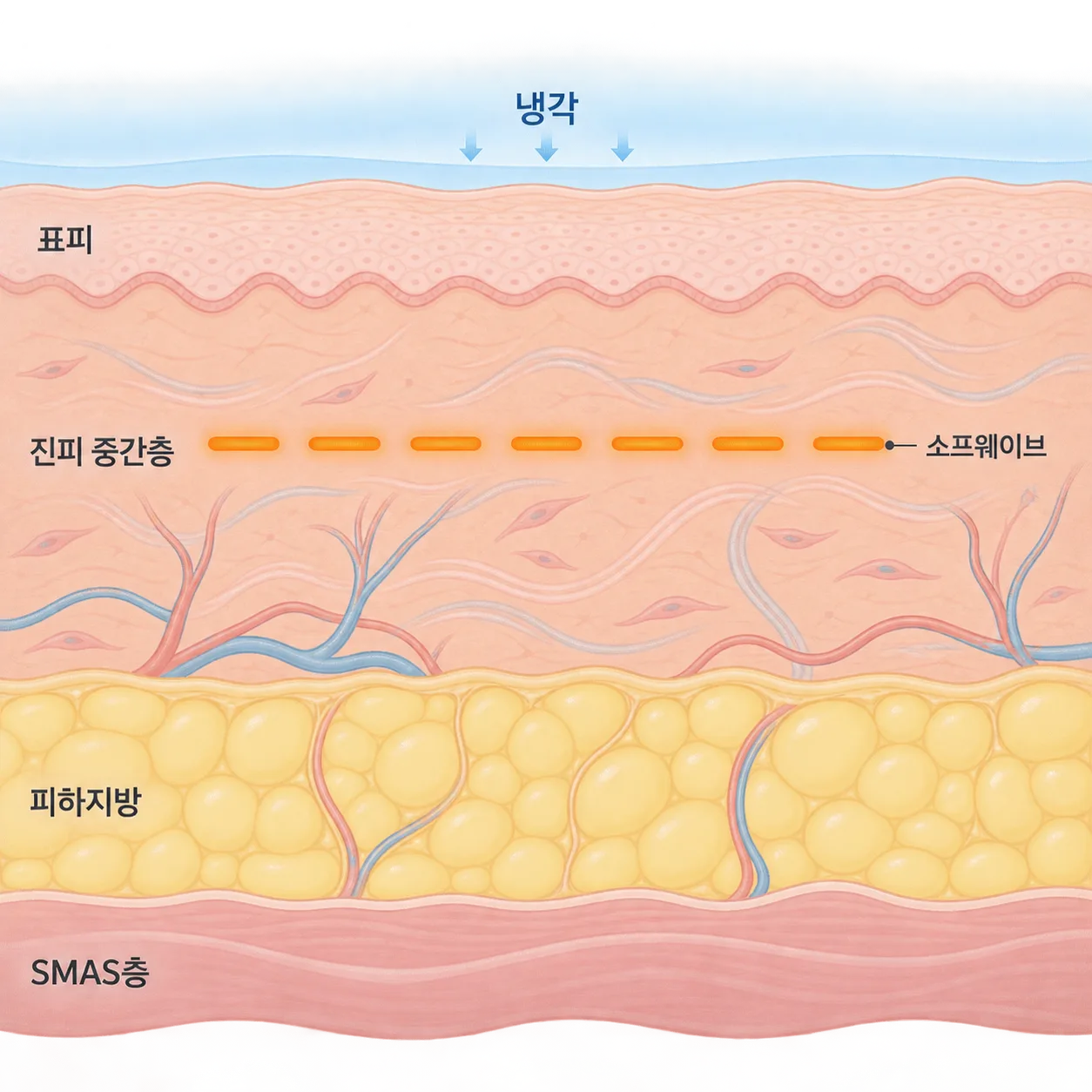 소프웨이브가 표피를 식히며 진피 중간층에 열을 모으는 자리