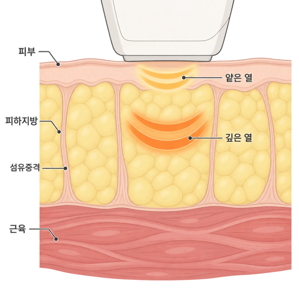 깊은 열은 피하지방 한가운데로, 얕은 열은 피부 바로 아래로 들어가요