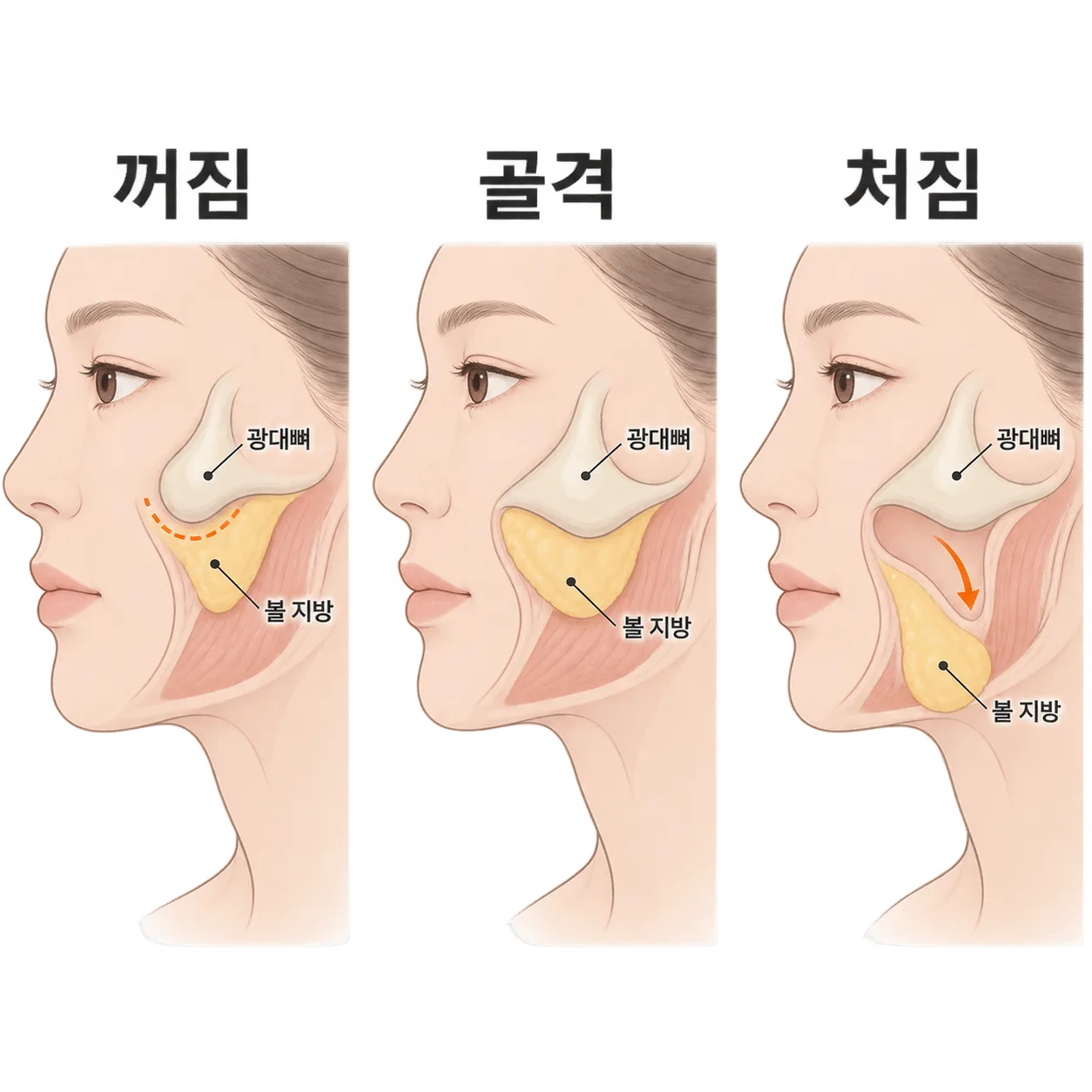 같은 옆볼 그늘도 꺼짐·골격·처짐 중 어디서 왔는지가 달라요