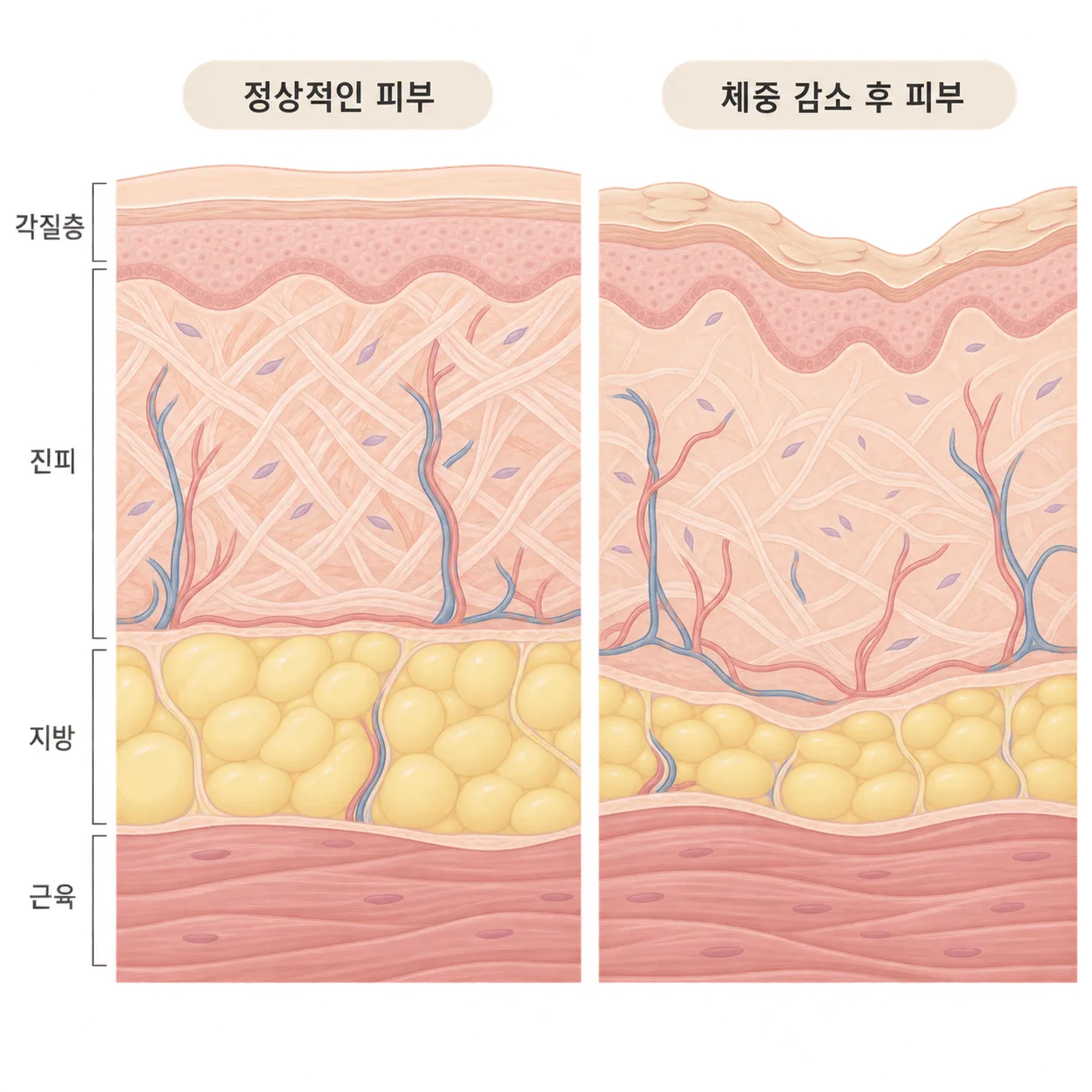 칙칙함은 맨 위 각질층에서, 늘어짐은 아래쪽 지방과 진피에서 시작돼요