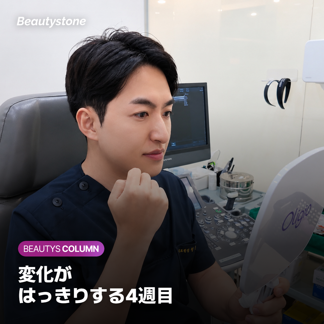 ボトックス後4週間で小鼻の広がりが減り、約6か月で戻る経過