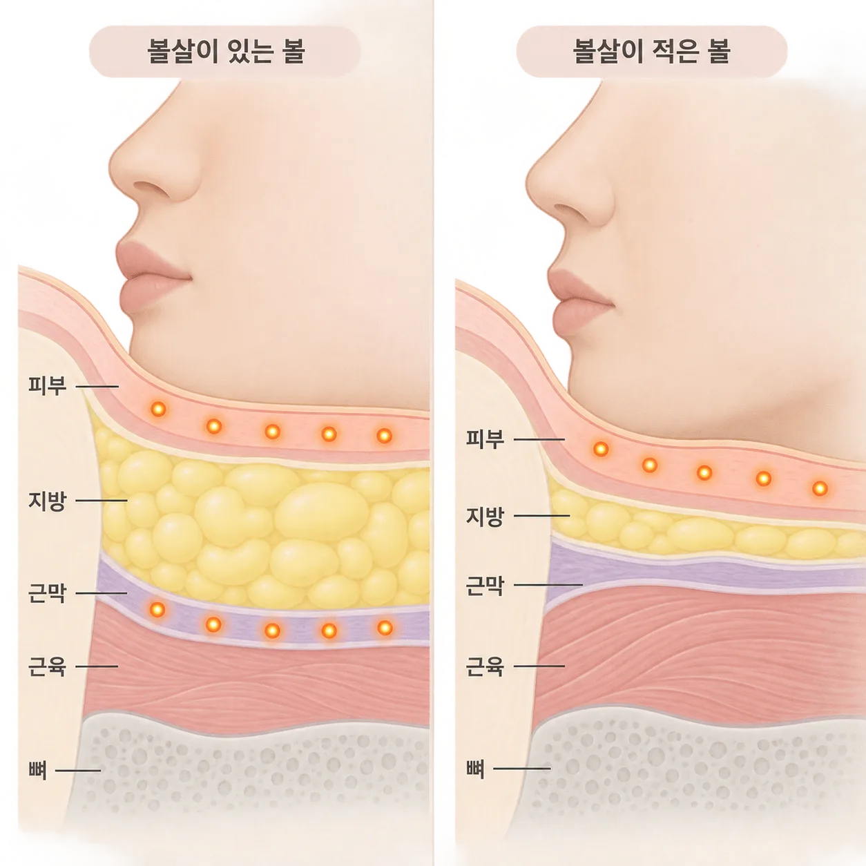 볼살이 얇은 자리는 지방층을 비워 두고, 볼살이 있는 자리는 깊은 층까지 나눠 넣어요