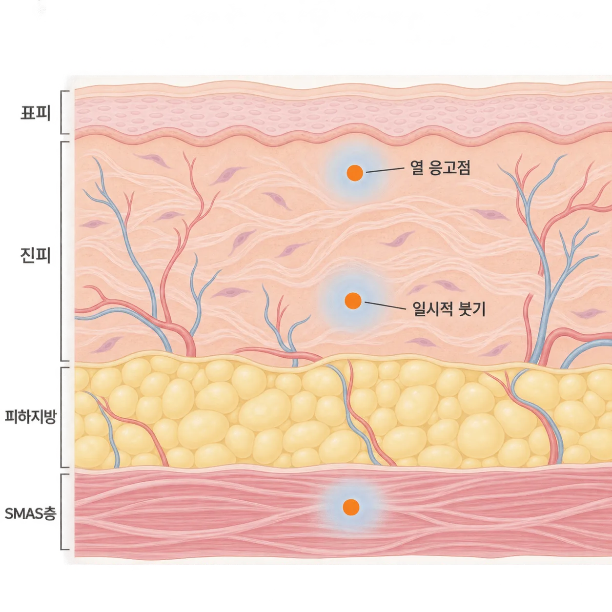 슈링크 열 응고점 주변에 잠시 생기는 붓기의 자리