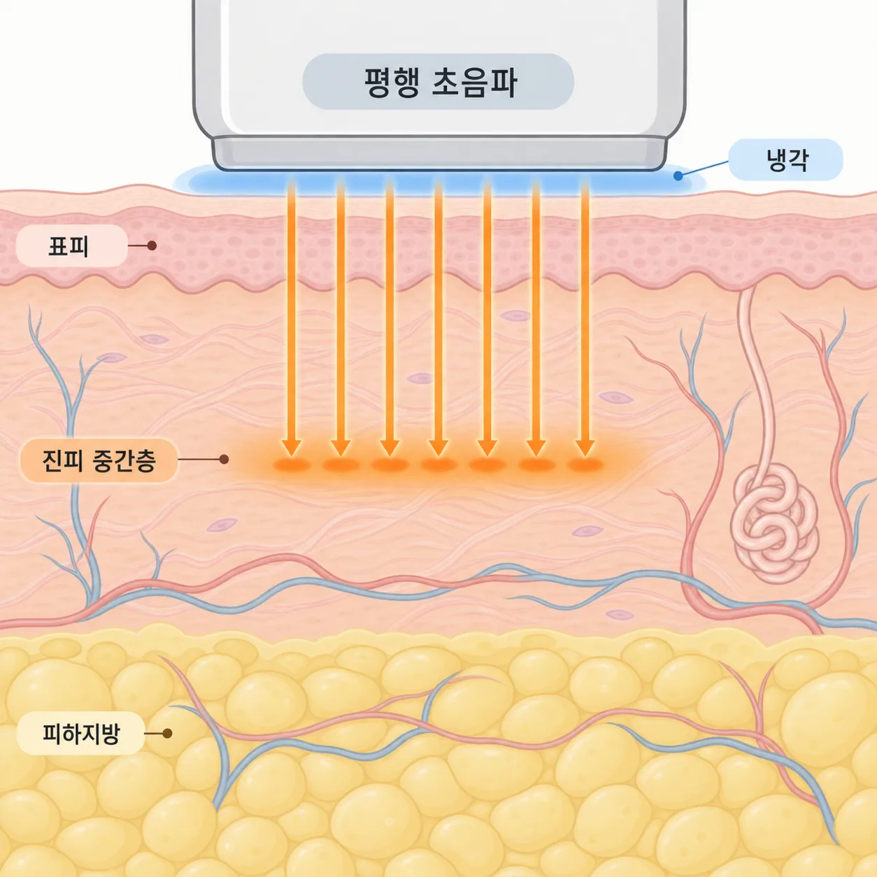 표면은 식히고 진피 중간층*에 열을 주는 평행 초음파의 단면