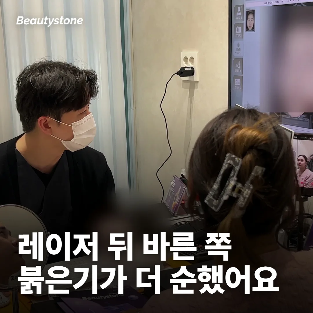 레이저 뒤 엑소좀을 바른 쪽은 붉은기가 더 순했어요