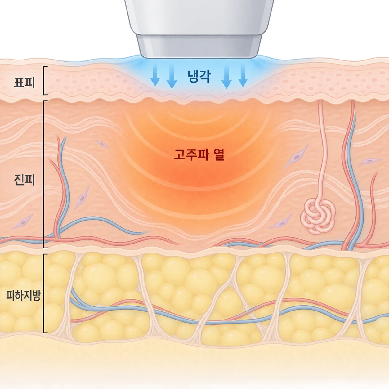 표면은 식히고 진피를 넓게 데우는 모노폴라 고주파의 열 분포