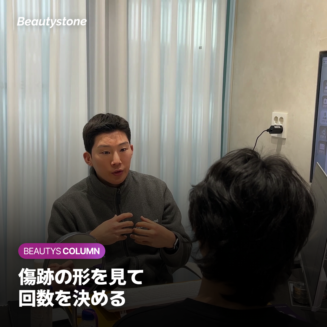 レーザーの回数を決める前にニキビ跡の形と深さを確認する医師
