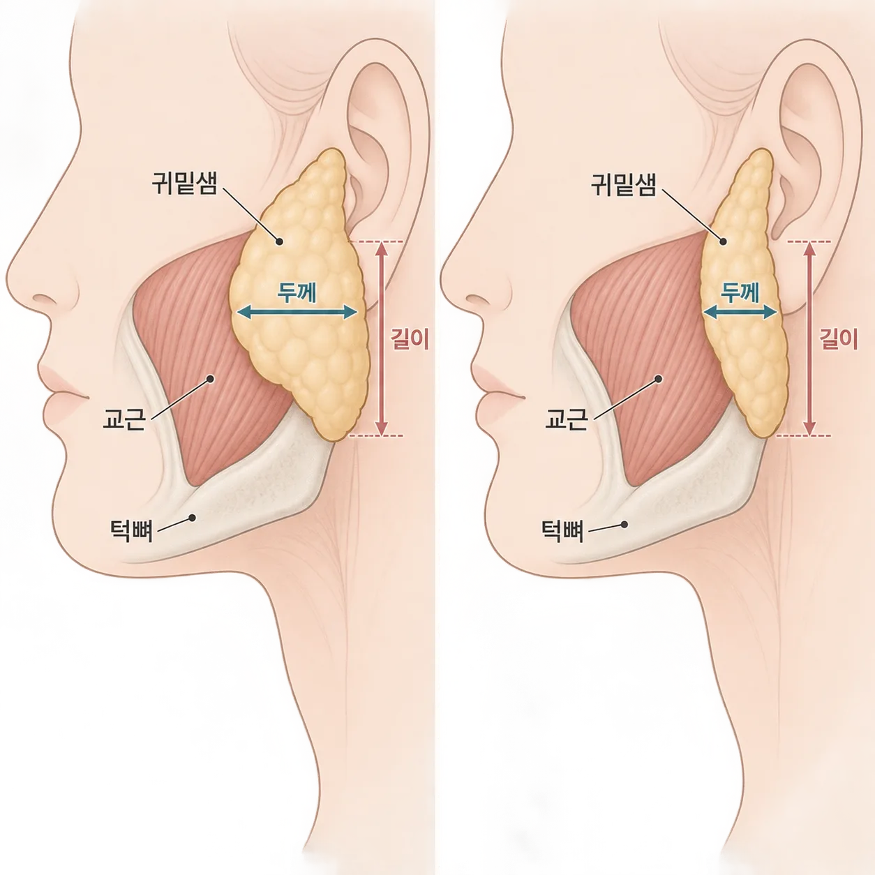 침샘 보톡스 뒤 귀밑샘은 두께가 줄고 위아래 길이는 크게 달라지지 않아요