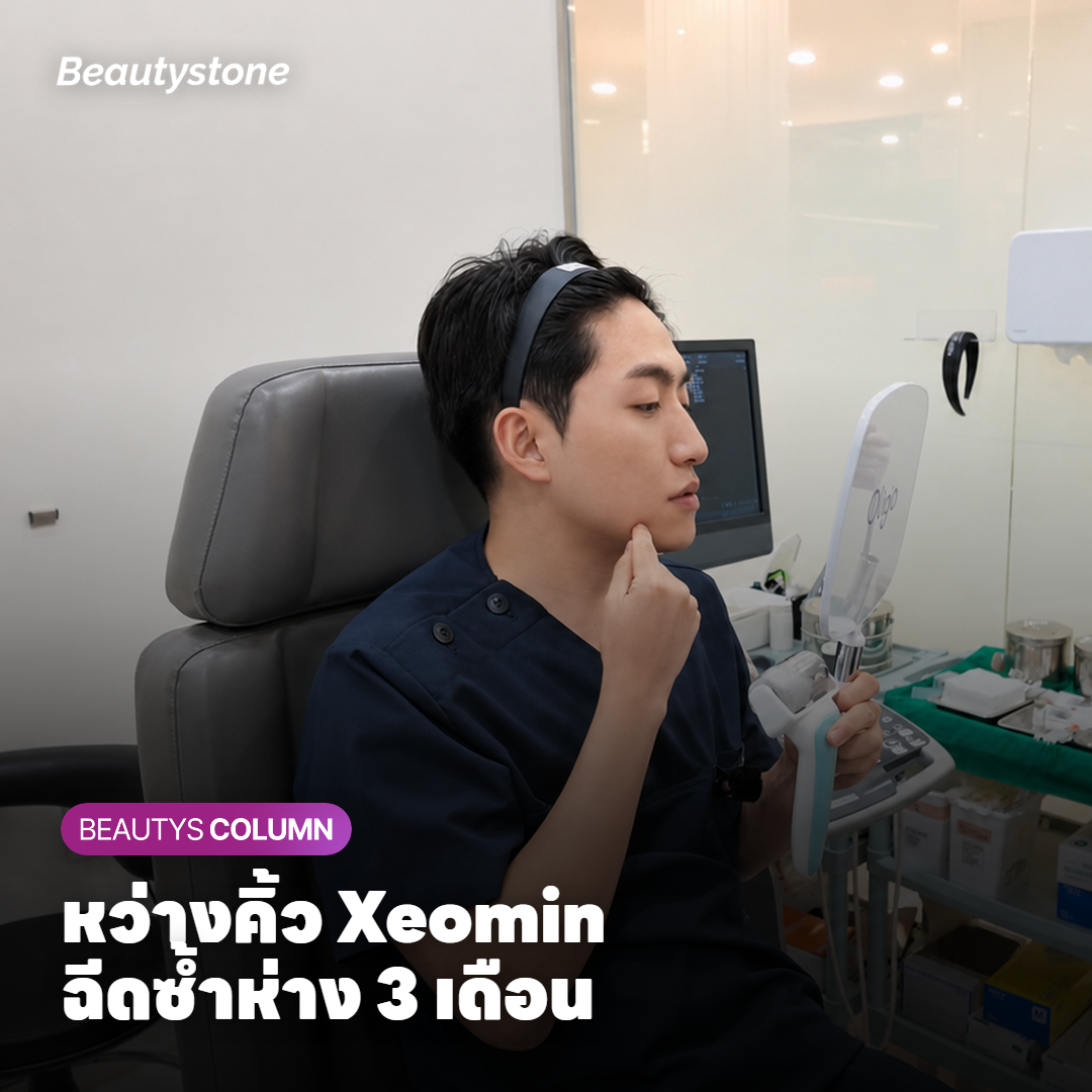 ภาพแสดงตำแหน่งฉีดห้าจุดบริเวณหว่างคิ้วเหนือขอบกระดูกคิ้ว