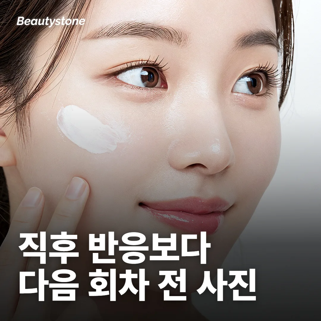 시술 직후 하얗게 크게 반응하면 잘 빠지는 거 아니에요?