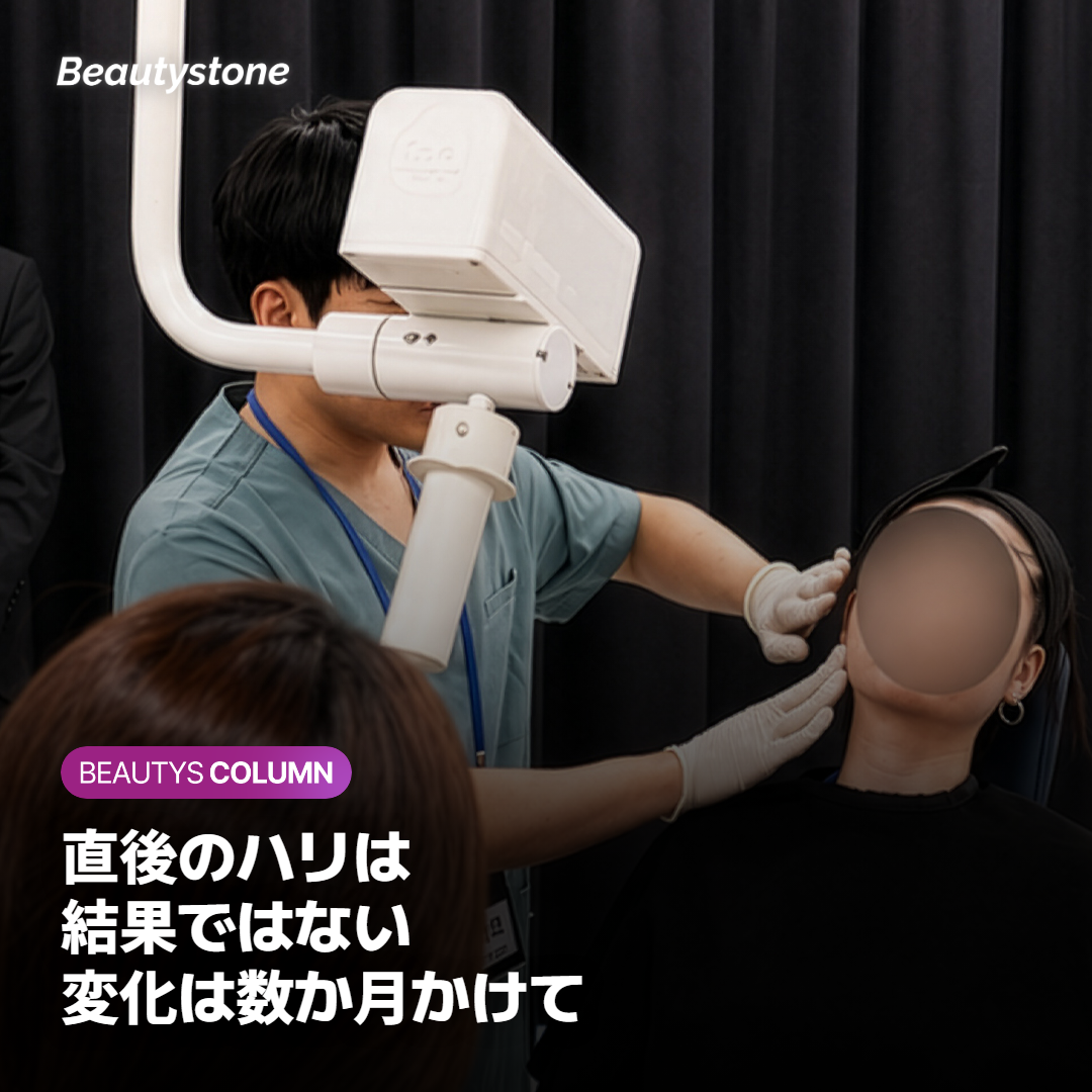 直後のハリは結果？ソフウェーブの効果が遅れて出る理由
