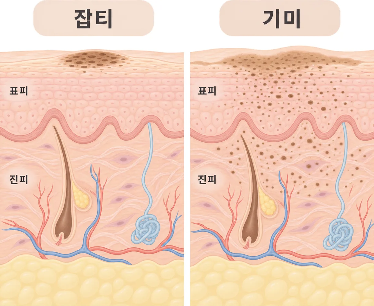 잡티는 얕고 또렷하게 모여 있고, 기미는 깊이가 섞여 넓게 퍼져 있어요