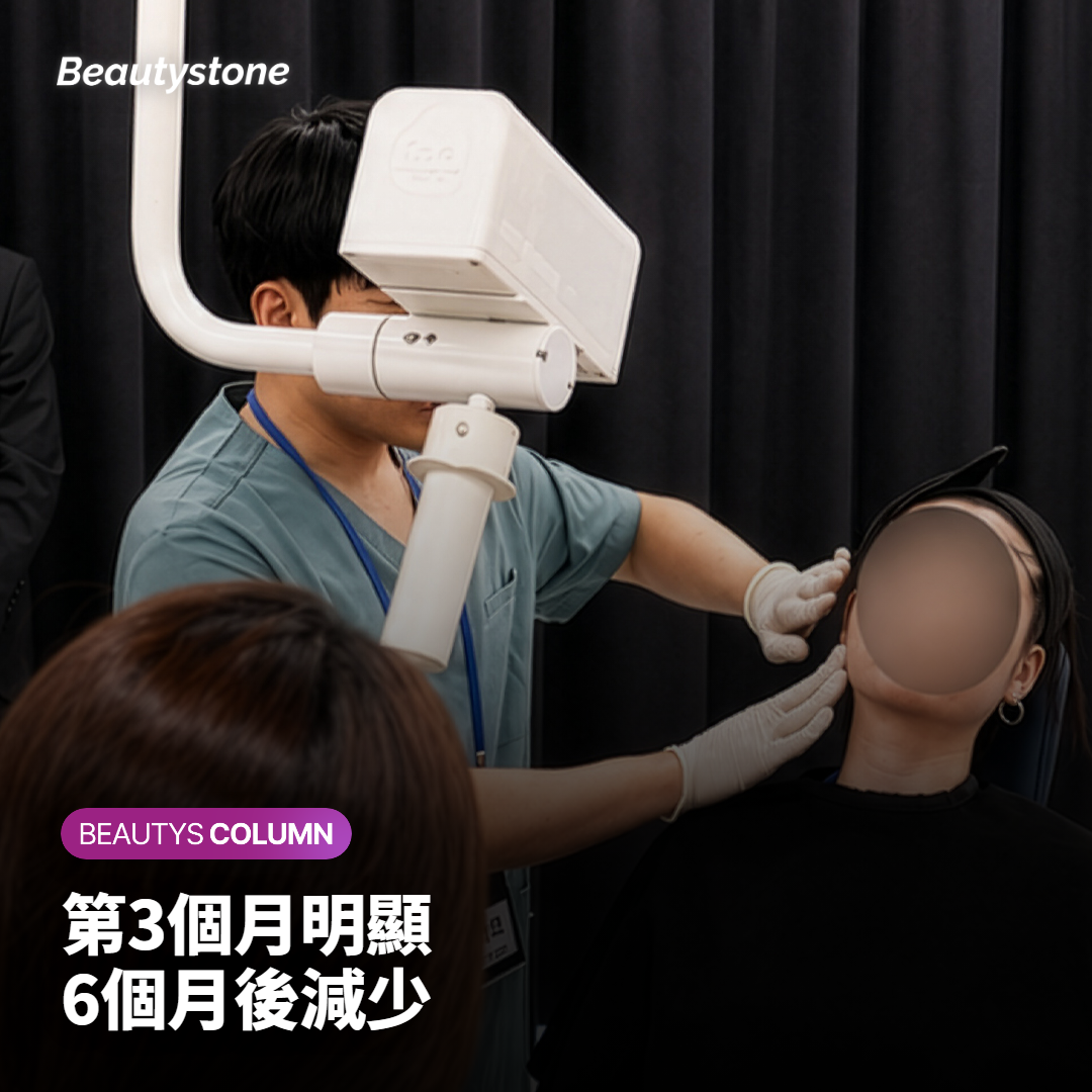 皮膚剖面示意圖：超音波在固定深度形成細小熱凝固點，組織慢慢收緊