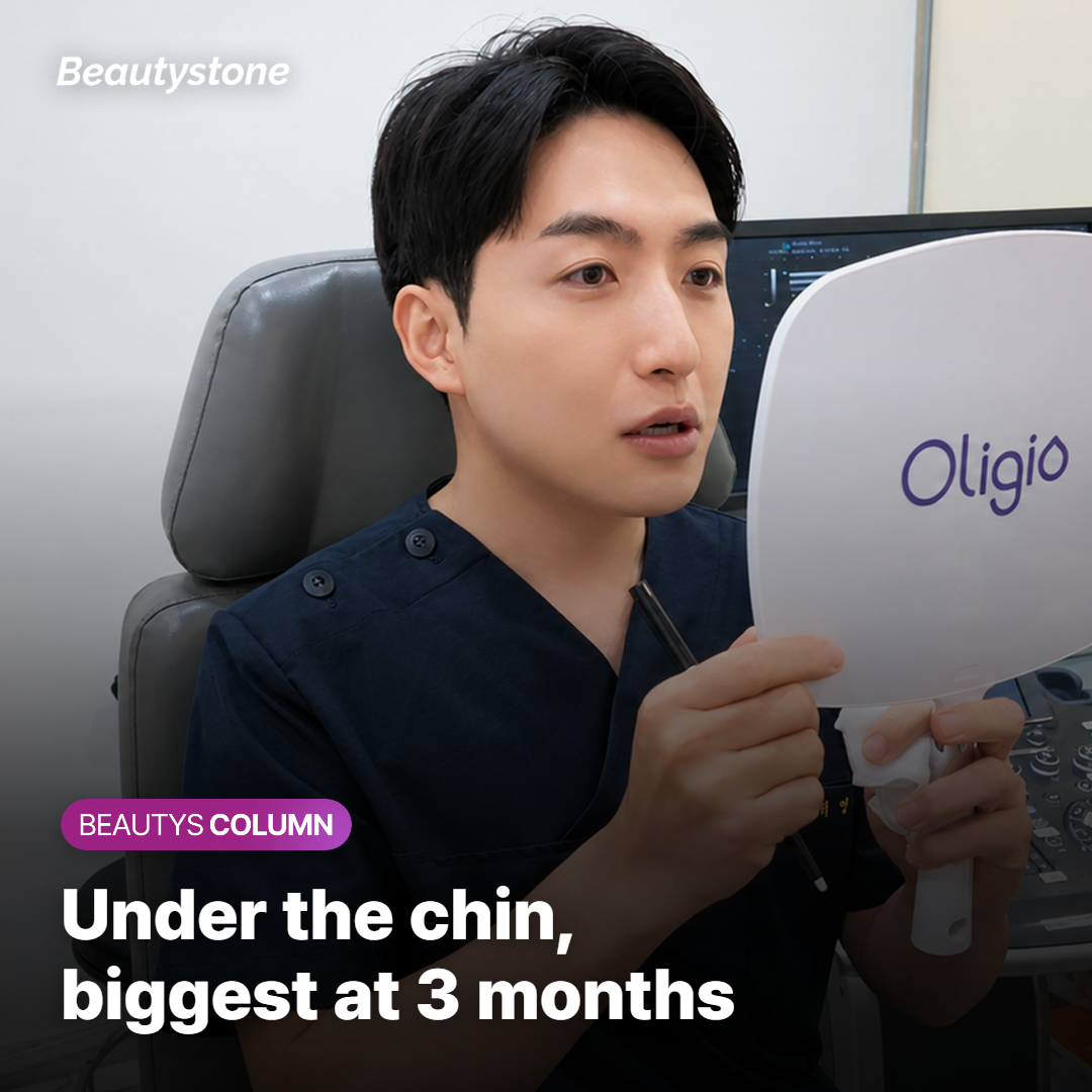 Bar chart of how far the area under the chin lifted at 90 and 180 days after one ultrasound lifting session