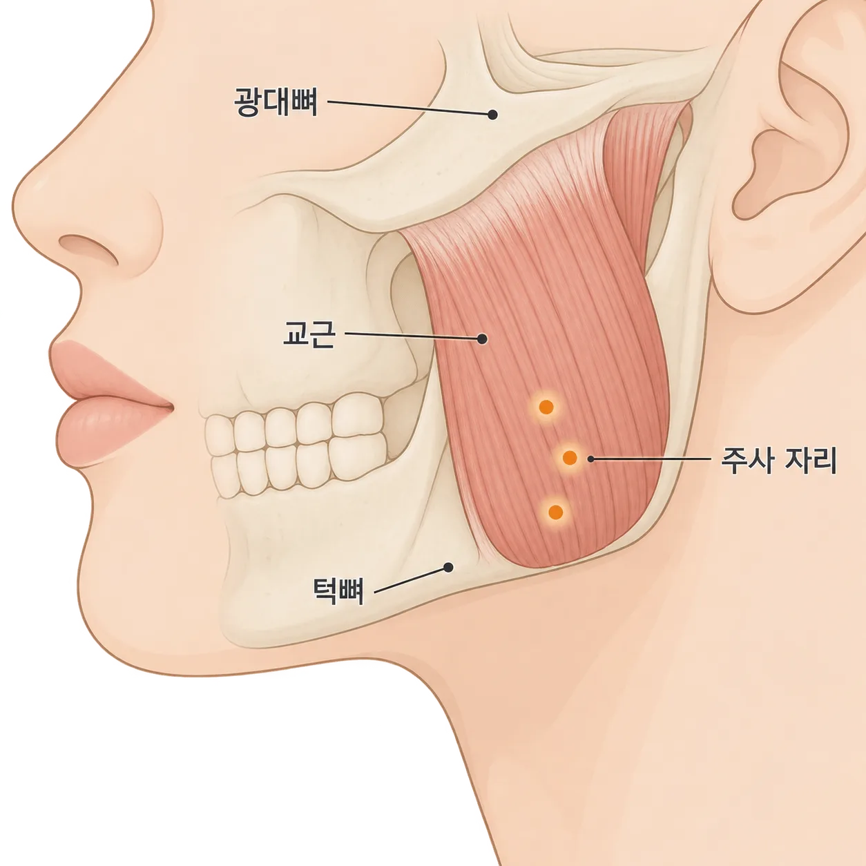 사각턱 보톡스는 턱 아래쪽 교근*에 놓아 근육 두께를 줄여요