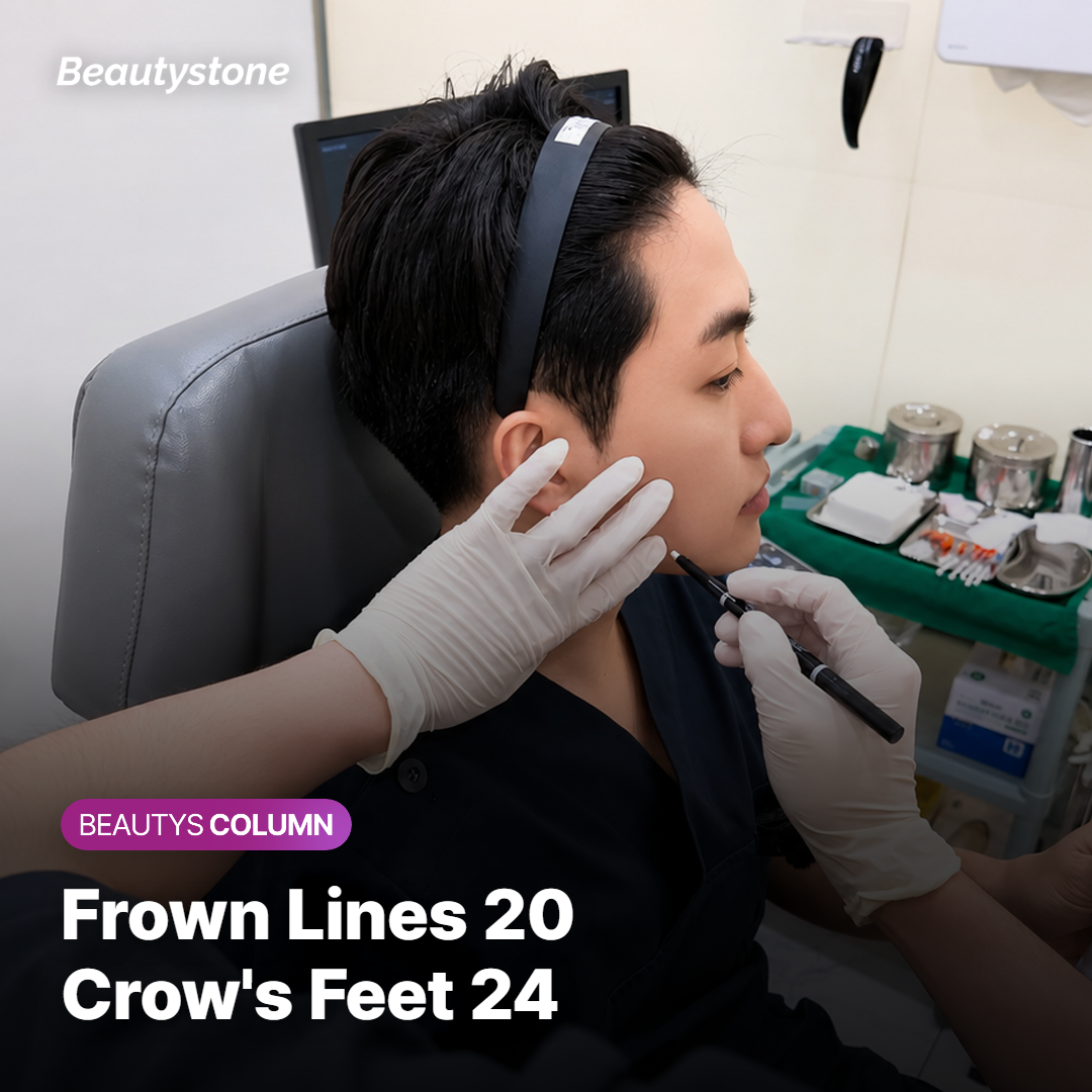 Injection points for frown lines between the brows and crow's feet beside the eyes