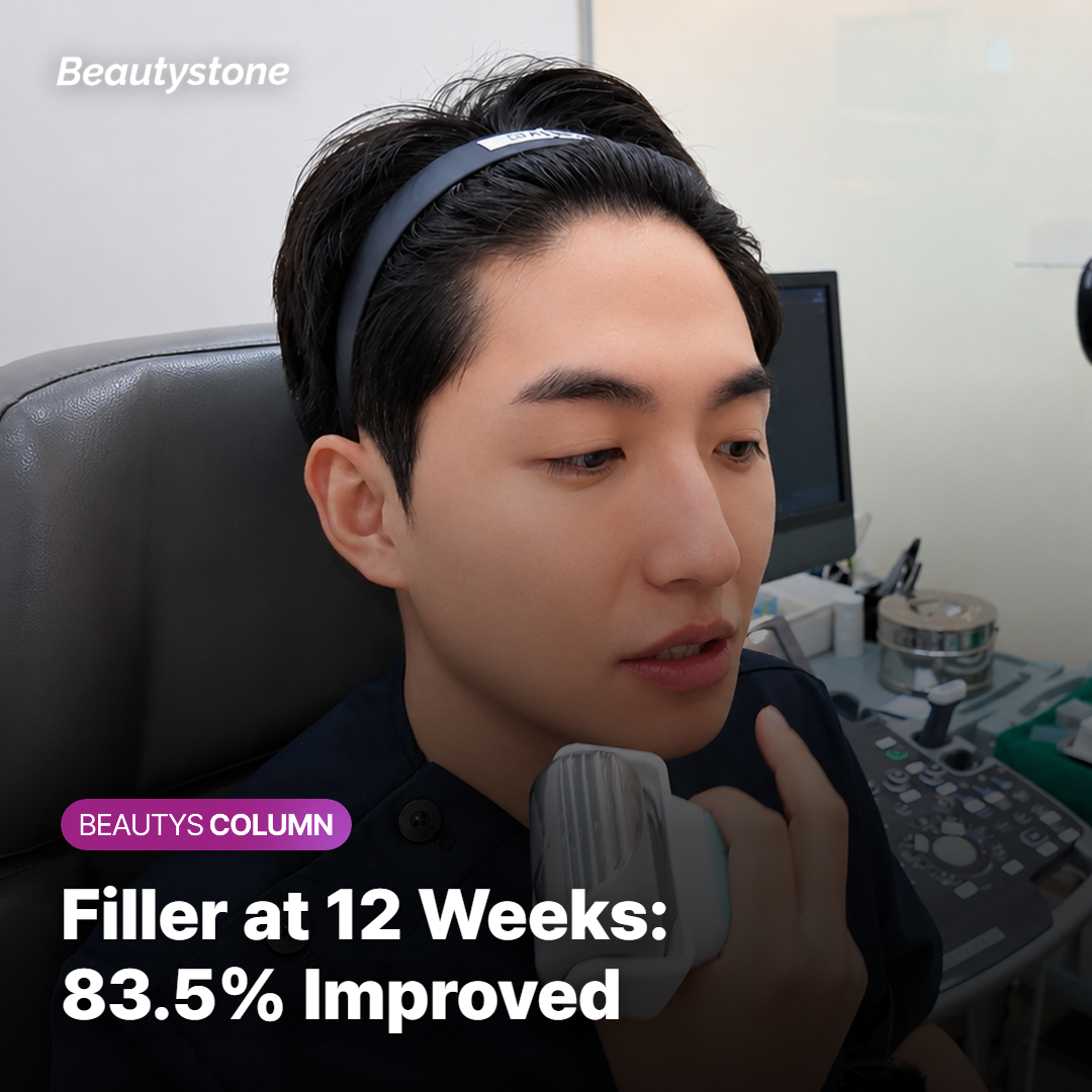 Filler placement area in the deep fat layer below the corner of the mouth
