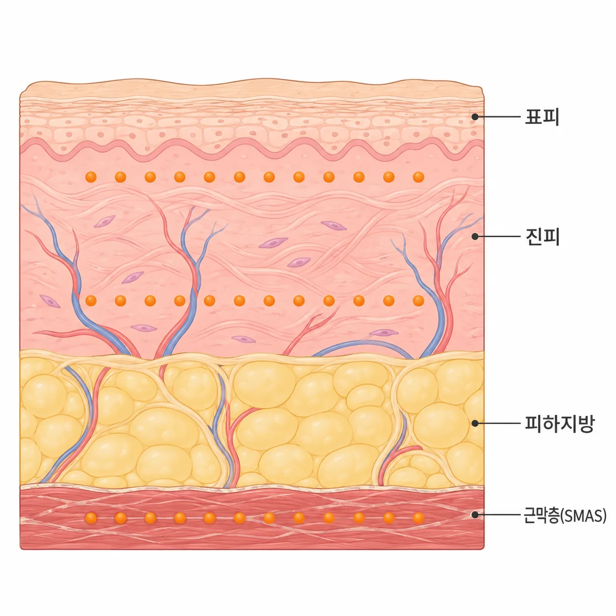 울쎄라 팁은 깊이마다 다른 층에 열점을 찍어요