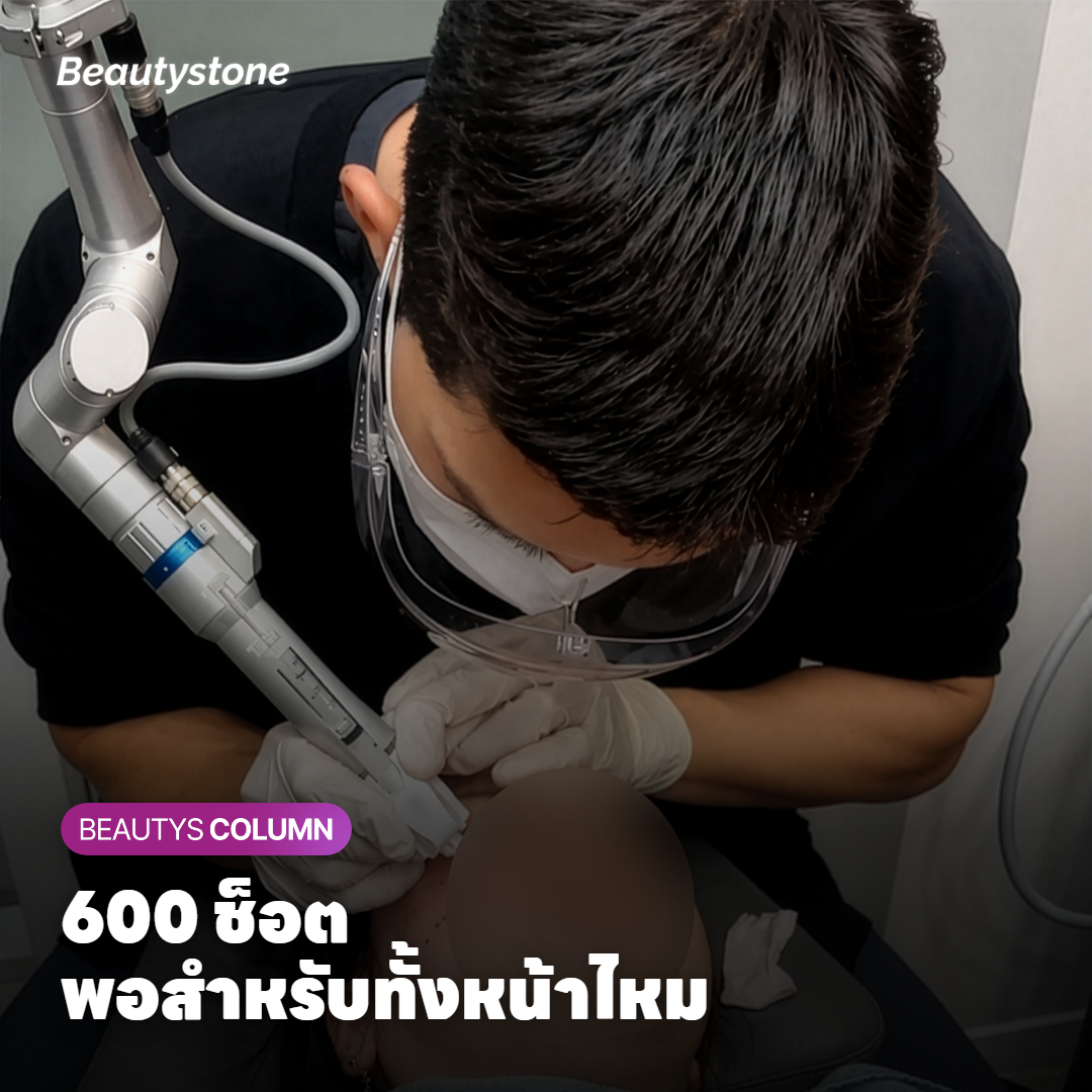 ภาพเปรียบเทียบบริเวณหน้าและคอที่ทำ Ulthera