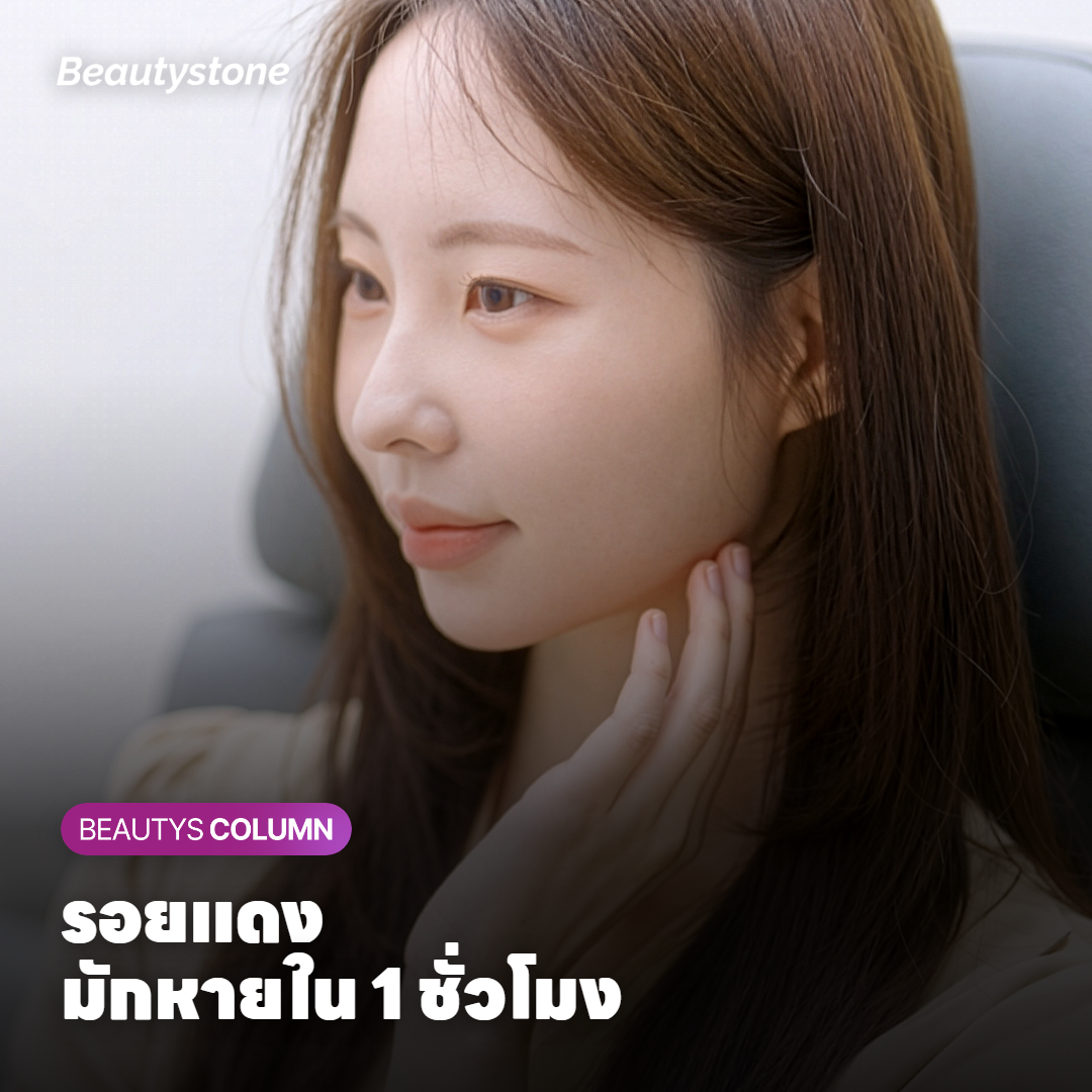 ผิวหน้าที่แดงเล็กน้อยหลังทำ Ulthera