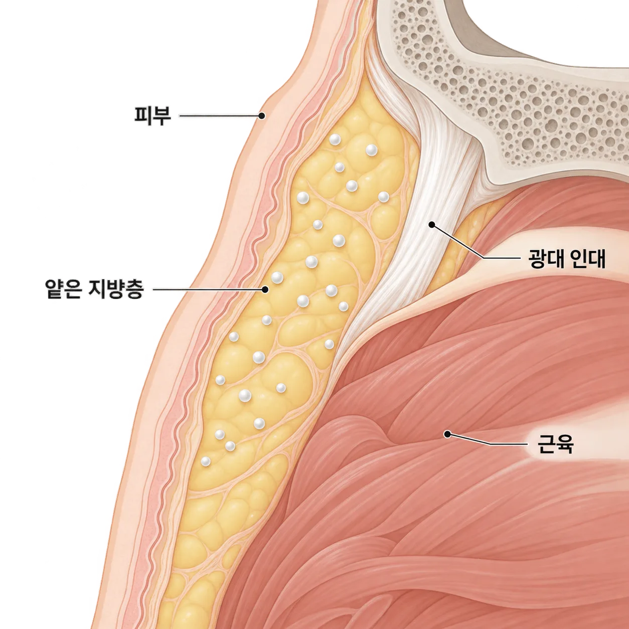 옆볼은 인대 아래 얕은 지방층에 묽게 나눠 넣어요