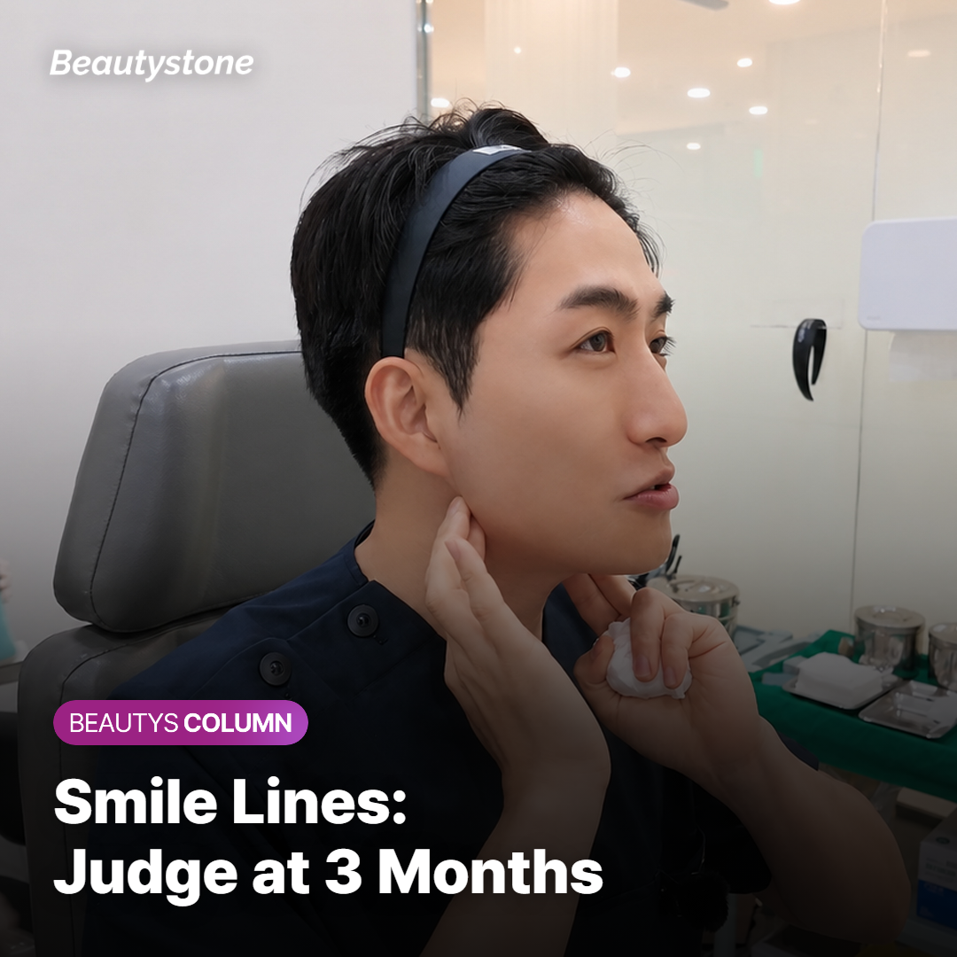 A side view of deep smile lines before a planned series of injections